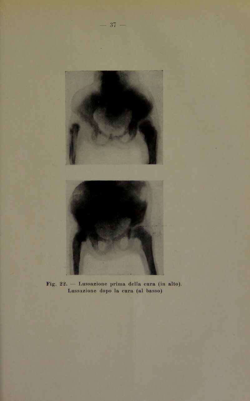 Fig. 22. — Lussazione prima della cura (in alto). Lussazione dopo la cura (al basso)