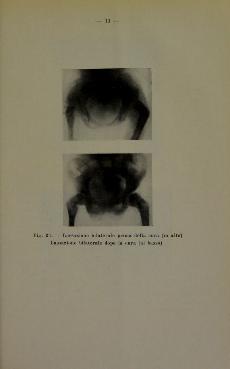 Fig. 24. — Lussazione bilaterale prima della cura (in alto) Lussazione bilaterale dopo la cura (al basso).