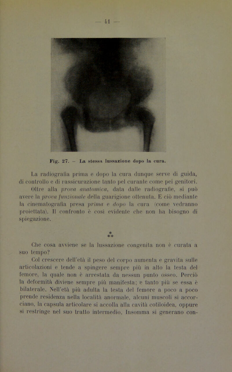 Fig. 27. - La stessa lussazione dopo la cura. La radiografia prima e dopo la cura dunque serve di guida, di controllo e di rassicurazione tanto pel curante come pei genitori. Oltre alla prova anatomica, data dalle radiografie, si può avere la prova funzionale della guarigione ottenuta. E ciò mediante la cinematografia presa prima e dopo la cura (come vedranno proiettata). Il confronto è così evidente che non ha bisogno di spiegazione. * ** Che cosa avviene se la lussazione congenita non è curata a suo tempo? Col crescere dell’età il peso del corpo aumenta e gravita sulle articolazioni e tende a spingere sempre più in alto la testa del femore, la quale non è arrestata da nessun punto osseo. Perciò la deformità diviene sempre più manifesta; e tanto più se essa è bilaterale. Nell’età più adulta la testa del femore a poco a poco prende residenza nella località anormale, alcuni muscoli si accor- ciano. la capsula articolare si accolla alla cavità cotiloidea, oppure si restringe nel suo tratto intermedio. Insomma si generano con-