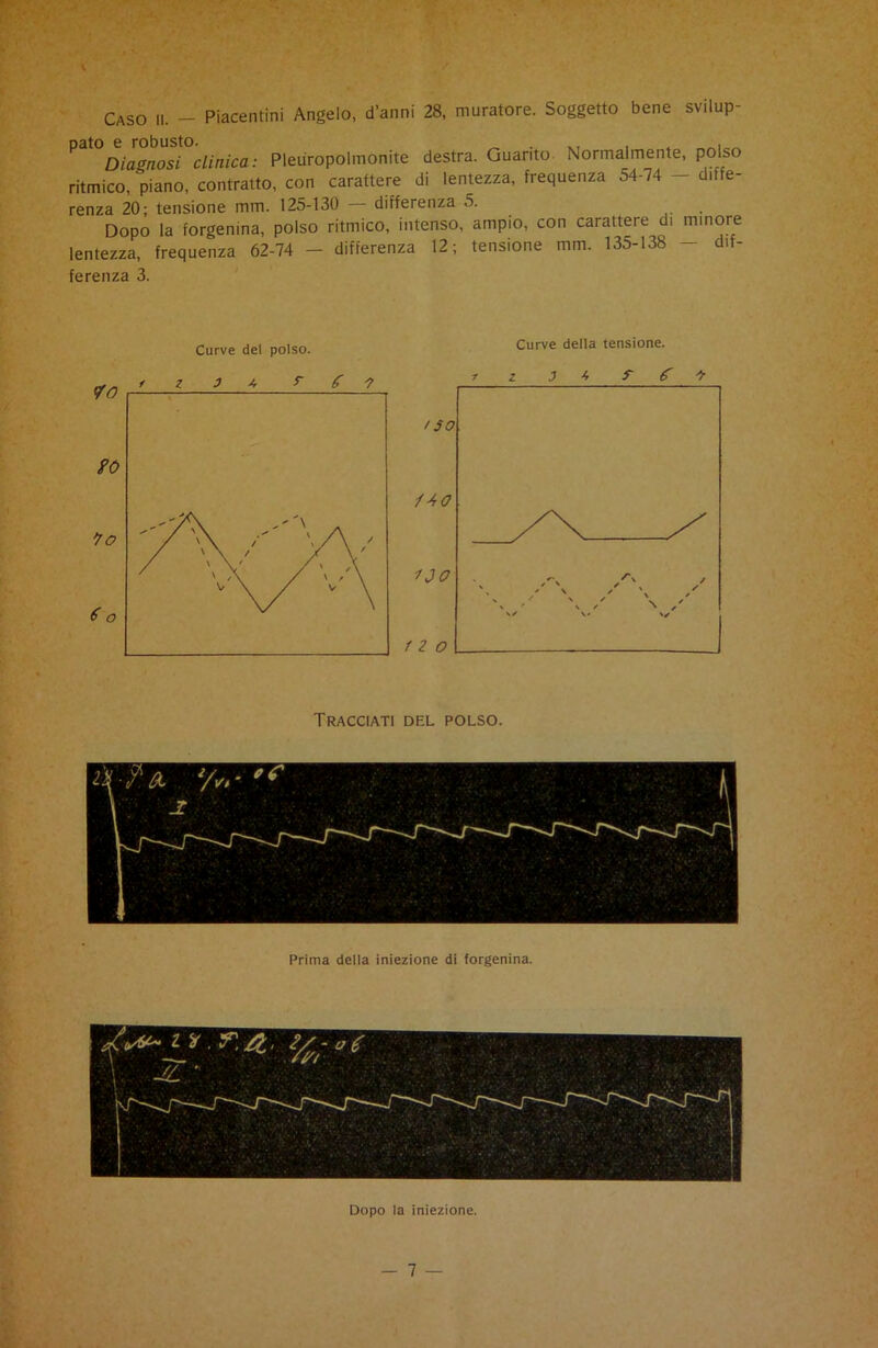 Caso li. - Piacentini Angelo, d’anni 28, muratore. Soggetto bene svilup- pato e robusto. „ . . ^ Diagnosi clinica: Pleuropolmonite destra. Guanto Normalmente, polso ritmico, piano, contratto, con carattere di lentezza, frequenza 54-74 - diffe- renza 20; tensione mm. 125-130 - differenza 5. Dopo la forgenina, polso ritmico, intenso, ampio, con carattere di minore lentezza, frequenza 62-74 - differenza 12; tensione mm. 135-138 - dif- ferenza 3. Curve del polso. Curve della tensione. Tracciati del polso. Prima della iniezione di forgenina. Dopo la iniezione.