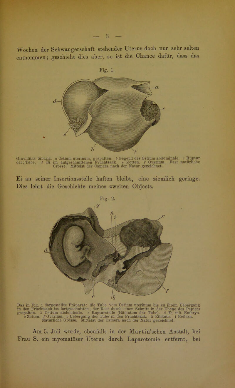 Wochen der Schwangerschaft stehender Uterus doch nur sehr selten entnommen; geschieht dies aber, so ist die Chance dafür, dass das Fig. 1. Graviditas tubaria. a Ostium uterinum, gespalten. 6 Gegend des Ostium abdominale, e Ruptur der j Tube, d Ei im aufgeschnittenen Fruchtsack, e Zotten, f Ovarium. Fast natürliche Grösse. Mittelst der Camera nach der Natur gezeichnet. Ei an seiner Insertionsstelle haften bleibt, eine ziemlich geringe. Dies lehrt die Geschichte meines zweiten Objects. Das in Fig. 1 dargestellte Präparat: die Tube vom Ostium uterinum bis zu ihrem Uebergang in den Fruohtsack ist fortgeschnitten, der Rest durch einen Schnitt in der Ebene des Papiers gespalten, h Ostium abdominale, c Rupturstelle (Hämatom der Tube), d Ei mit Embryo, e Zotten, f Ovarium. a Uebergang der Tube in den Fruchtsack, h Eihäute, i Reflexa. Natürliche Grösse. Mittelst der Camera nach der Natur gezeichnet. Fig. 2. Am 5. Juli wurde, ebenfalls in der Martin’schen Anstalt, bei Frau S. ein myomatöser Uterus durch Laparotomie entfernt, bei