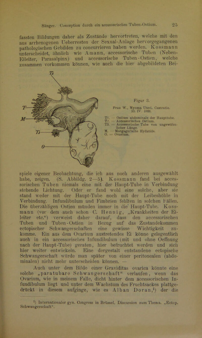 fassten Bildnng-en daher als Zustände hervortreten, welche mit den aus airhenogenen Ueberresten der Sexual-Anlage hervorgegangenen pathologisclien Gebilden zu concurrieren haben werden. Kossmann unterscheidet, ähnlich wie Amann, accessorische Tuben (Neben- Eileiter, Parasalpinx) und accessorische Tuben - Ostien, welche zusammen verkommen können, wie auch die hiei' abgebildeten Bei- Figur 3. Frau W., Myoma Uteri. Castratio. 10. IV 1888. TI. Ostinm abdominale der Hanpttube. T-'. = Accessoriaclies Ostium. T3. = Accessorische Tube von ungewöhn- licher Länge. M. Morgagni’sche Hydatide. 0. = Ovarium. spiele eigener Beobachtung, die ich aus noch andei'en ausgewählt habe, zeigen. (S. Abbildg. 2—5). Kossmann fand bei acces- sorischen Tuben niemals eine mit der Haupt-Tube in Verbindung stehende Lichtung. Oder er fand wohl eine solche, aber sie stand weder mit der Haupt-Tube noch mit der Leibeshöhle in Verbindung. Infundibulum und Fimbrien fehlten in solchen Fällen. Die überzähligen Ostien münden immer in die' Flaupt-Tube. Koss- mann (vor dem auch schon C. Hennig, „Krankheiten der Ei- leiter etc.“) verweist daher darauf, dass den accessorischen Tuben und Tuben-Ostien in Bezug auf das Zustandekommen ectopischer Schwangerschaften eine gewisse Wichtigkeit zu- komme. Ein aus dem Ovarium austretendes lüi könne gelegentlich auch in ein accessonsches Infundibulum (mit und ohne Oetfnung nach der Haupt-Tube) geraten, hier befruchtet werden und sich hier weiter entwickeln. Eine dergestalt entstandene ectopische Schwangerschaft würde man später von einer peritonealen (abdo- minalen) nicht mehr unterscheiden können. — Auch unter dem Bilde einer Graviditas ovaiica könnte eine solche „paratubaro Schwangerschaft“ verlaufen, wenn das Ovarium, wie in meinem Falle, dicht hinter dem accessorischen Jn- fundibnlum liegt und nntei- dem Wachstum des Fruchtsackes plattge- drückt in diesem aufginge, wie es Alban Doran,*) der die ') Iiiternatioiialür gyn. Congrcss in Brüssel, Discussion znin Thema. „Rctop. Schwangersclnil'f.