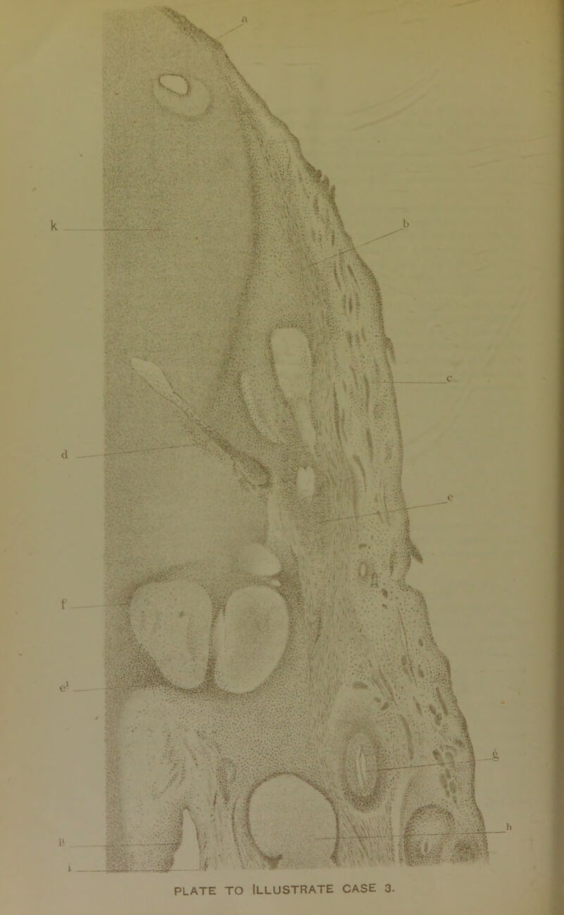 PLATE TO Illustrate case 3