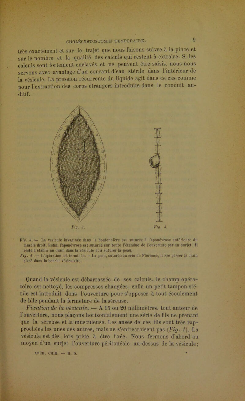 très exactement et sue le trajet que nous faisons suivre à la pince et sur le nombre et la qualité des calculs qui restent à extraire. Si les calculs sont fortement enclavés et ne peuvent être saisis, nous nous servons avec avantage d’un courant d’eau stérile dans l'intérieur de la vésicule. La pression récurrente du liquide agit dans ce cas comme pour l’extraction des corps étrangers introduits dans le conduit au- ditif. Fig. 3. Fig. 4. Fig. 3. — La vésicule invaginée dans la boutonnière est suturée à l'aponévrose antérieure du muscle droit. Enlin, l’aponévrose est suturée sur toute l’étendue de l’ouverture par un surjet. Il reste a établir un drain dans la vésicule et à suturer la peau. Fig. 4. — L’opération est terminée. — La peau, suturée au crin de Florence, laisse passer le drain placé dans la bouche vésiculaire. Quand la vésicule est débarrassée de ses calculs, le champ opéra- toire est nettoyé, les compresses changées, enfin un petit tampon sté- rile est introduit dans l’ouverture pour s’opposer à tout écoulement de bile pendant la fermeLure de la séreuse. Fixation de la vésicule. — A lo ou 20 millimètres, tout autour de l’ouverture, nous plaçons horizontalement une série de fils ne prenant que la séreuse et la musculeuse. Les anses de ces fils sont très rap- prochées les unes des autres, mais ne s’entrecroisent pas [Fig. 1). La vésicule est dès lors prête à être fixée. Nous fermons d’abord au moyen d’un surjet l’ouverture péritonéale au-dessus de la vésicule; AUCIl. cmn. — H. t>.