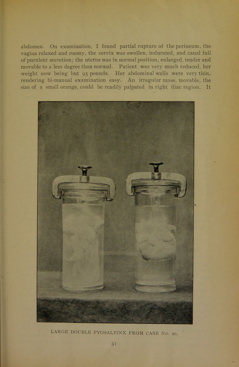 abdomen. On examination, I found partial rupture of the perineum, the vagina relaxed and roomy, the cervix was swollen, indurated, and canal full of purulent secretion; the uterus was in normal position, enlarged, tender and movable to a less degree than normal. Patient was very much reduced, her weight now being but 95 pounds. Her abdominal walls were very thin, rendering bi-manual examination easy. An irregular mass, movable, the size of a small orange, could be readily palpated in right iliac region. It LARGE DOUBLE PYOSALPINX FROM CASE No. 20. 3'