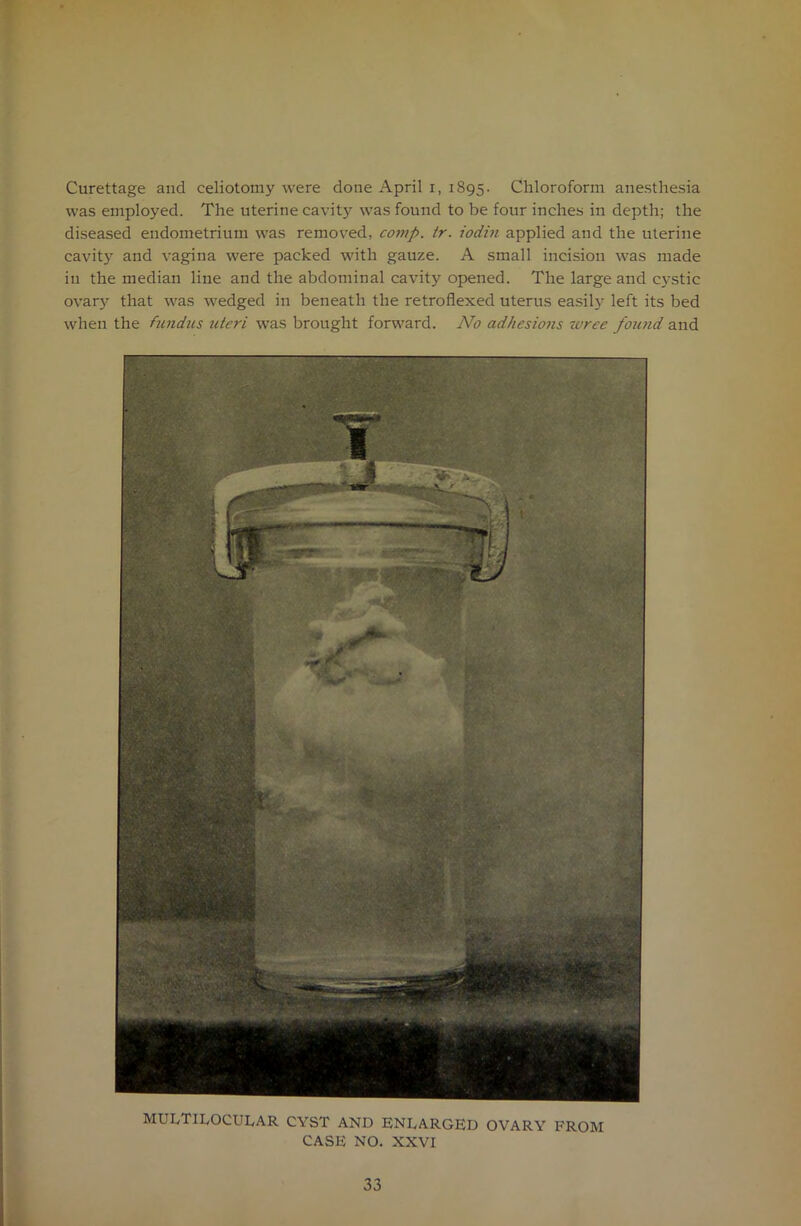 Curettage and celiotomy were done April i, 1895. Chloroform anesthesia was employed. The uterine cavitj^ was found to be four inches in depth; the diseased endometrium was removed, comp. tr. iodin applied and the uterine cavity and vagina were packed with gauze. A small incision was made in the median line and the abdominal cavity opened. The large and cystic ovary that was wedged in beneath the retroflexed uterus easily left its bed when the fundus uteri was brought forward. No adhesions wrcc found and MULTILOCULAR CYST AND ENLARGED OVARY FROM CASE NO. XXVI