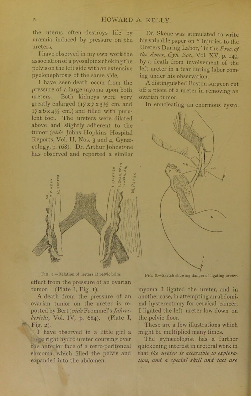 the uterus often destroys life by uraemia induced by pressure on the ureters. I have observed in my own work the association of a pyosalpinx choking the pelvis on the left side with an extensive pyelonephrosis of the same side. I have seen death occur from the pressure of a large myoma upon both ureters. Both kidneys were very greatly enlarged (17x7x5*4 cm. and 17x6x4)4 cm.) and filled with puru- lent foci. The ureters were dilated above and slightly adherent to the tumor (vide Johns Hopkins Hospital Reports, Vol. II, Nos. 3 and 4, Gynae- cology^. 168). Dr. Arthur Johnstone has observed and reported a similar 0 o «- ^ > < Fig. 7.—Relation of ureters at pelvic brim. effect from the pressure of an ovarian tumor. (Plate I, Fig. 1). A death from the pressure of an ovarian tumor on the ureter is re- ported by Bert (s/zV&Frommel’s Jahrcs- bericht, Vol. IV, p. 684). (Plate I, Fig. 2). I have observed in a little girl a •ge right hydro-ureter coursing over rhe anterior face of a retro-peritoneal sarcoma, wlrich filled the pelvis and expanded into the abdomen. Dr. Skene was stimulated to write his valuable paper on “ Injuries to the Ureters During Labor,” in the Proc. of the Amer. Gyn. Soc., Vol. XV, p. 149, by a death from involvement of the left ureter in a tear during labor com- ing under his observation. A distinguished Boston surgeon cut off a piece of a ureter in removing an ovarian tumor. In enucleating an enormous cysto- myoma I ligated the ureter, and in another case, in attempting an abdomi- nal hysterectomy for cervical cancer, I ligated the left ureter low down on the pelvic floor. These are a few illustrations which might be multiplied many times. The gynaecologist has a further quickening interest in ureteral work in that the ureter is accessible to explora- tion, and a special skill and tact are