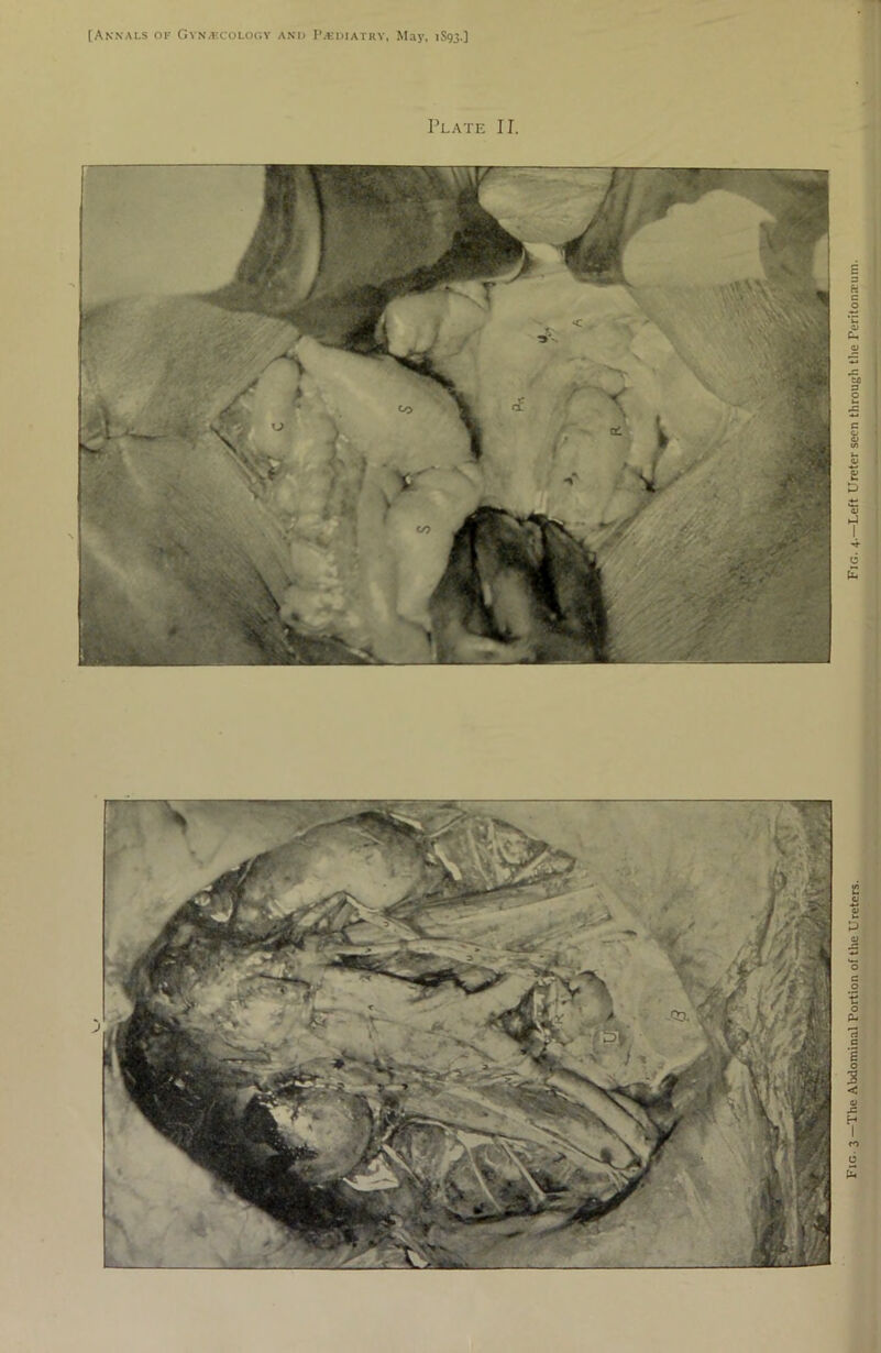 Plate II. Fig. 3—The Abdominal Portion of the Ureters. Fig. 4.—Left Ureter seen through the Peritoneum.