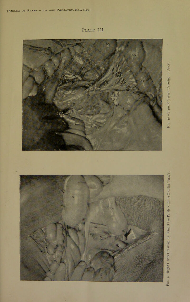 Plate III. Fig. 5.—Right Ureter Crossing the Brim of the Pelvis with the Ovarian Vessels. Fig. 10 —Sigmoid Vessels Covering in Ureter.