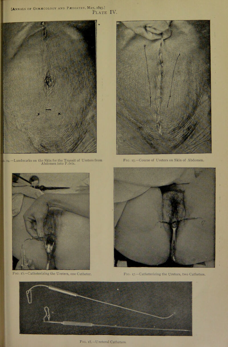 Plate IV. !. 14.—Landmarks on the Skin for the Transit of Ureters from Fig. 15.—Course of Ureters on Skin of Abdomen. Abdomen into Pelvis. Fig. iS.—Ureteral Catheters.