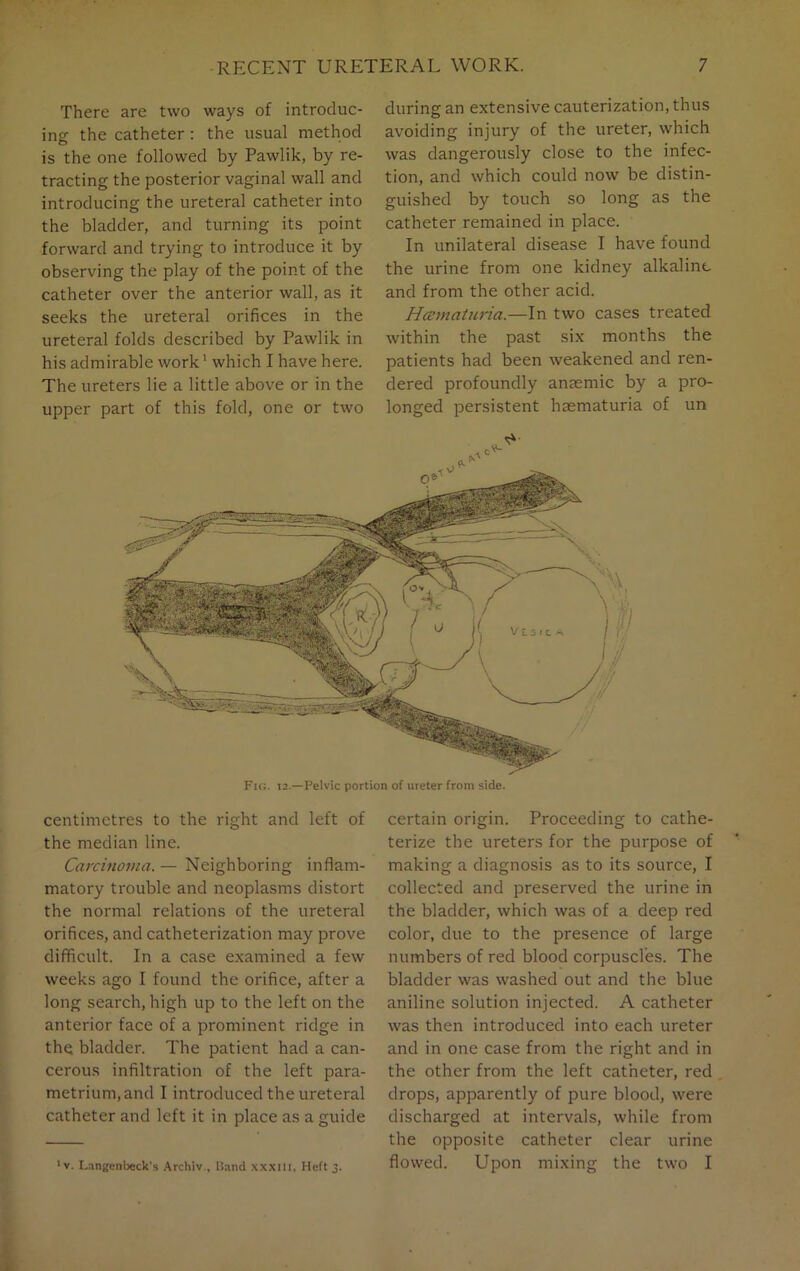 There are two ways of introduc- ing: the catheter : the usual method is the one followed by Pawlik, by re- tracting the posterior vaginal wall and introducing the ureteral catheter into the bladder, and turning its point forward and trying to introduce it by observing the play of the point of the catheter over the anterior wall, as it seeks the ureteral orifices in the ureteral folds described by Pawlik in his admirable work1 which I have here. The ureters lie a little above or in the upper part of this fold, one or two during an extensive cauterization, thus avoiding injury of the ureter, which was dangerously close to the infec- tion, and which could now be distin- guished by touch so long as the catheter remained in place. In unilateral disease I have found the urine from one kidney alkaline and from the other acid. Hcematuria.—In two cases treated within the past six months the patients had been weakened and ren- dered profoundly anaemic by a pro- longed persistent haematuria of un Fig. 12.—Pelvic portion of ureter from side. centimetres to the right and left of the median line. Carcinoma. — Neighboring inflam- matory trouble and neoplasms distort the normal relations of the ureteral orifices, and catheterization may prove difficult. In a case examined a few weeks ago I found the orifice, after a long search, high up to the left on the anterior face of a prominent ridge in the bladder. The patient had a can- cerous infiltration of the left para- metrium, and I introduced the ureteral catheter and left it in place as a guide 1 v. Langenbeck’s Archiv , Hand xxxm, Heft 3. certain origin. Proceeding to cathe- terize the ureters for the purpose of making a diagnosis as to its source, I collected and preserved the urine in the bladder, which was of a deep red color, due to the presence of large numbers of red blood corpuscles. The bladder was washed out and the blue aniline solution injected. A catheter was then introduced into each ureter and in one case from the right and in the other from the left catheter, red drops, apparently of pure blood, were discharged at intervals, while from the opposite catheter clear urine flowed. Upon mixing the two I