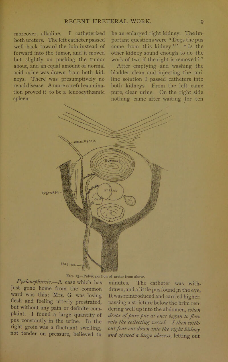 moreover, alkaline. I catheterized both ureters. The left catheter passed well back toward the loin instead of forward into the tumor, and it moved but slightly on pushing the tumor about, and an equal amount of normal acid urine was drawn from both kid- neys. There was presumptively no renal disease. A more careful examina- tion proved it to be a leucocythaemic spleen. be an enlarged right kidney. The im- portant questions were “ Do§s the pus come from this kidney ? ” “ Is the other kidney sound enough to do the work of two if the right is removed ? ” After emptying and washing the bladder clean and injecting the ani- line solution I passed catheters into both kidneys. From the left came pure, clear urine. On the right side nothing came after waiting for ten Urctsf.^ Fig. 13.—Pelvic portion of ureter from above. Pyelonephrosis.—A case which has just gone home from the common ward was this: Mrs. G. was losing flesh and feeling utterly prostrated, but without any pain or definite com- plaint. I found a large quantity of pus constantly in the urine. In the right groin was a fluctuant swelling, not tender on pressure, believed to minutes. The catheter was with- drawn, and a little pus found jn the eye, It was reintroduced and carried higher, passing a stricture below the brim ren- dering well up into the abdomen, when drops of pure pus at once began to flow into the collecting vessel. I then with- out fear cut down into the right kidney and ope?ied a large abscess, letting out