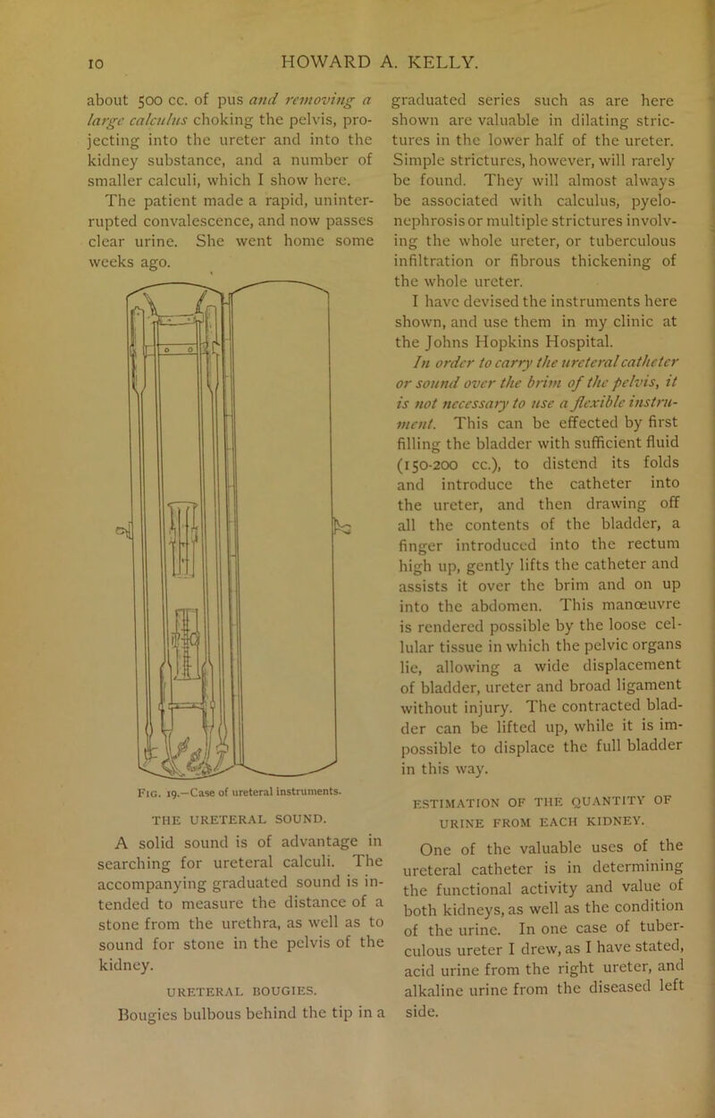 about 500 cc. of pus and removing a large calculus choking the pelvis, pro- jecting into the ureter and into the kidney substance, and a number of smaller calculi, which I show here. The patient made a rapid, uninter- rupted convalescence, and now passes clear urine. She went home some weeks ago. THE URETERAL SOUND. A solid sound is of advantage in searching for ureteral calculi. The accompanying graduated sound is in- tended to measure the distance of a stone from the urethra, as well as to sound for stone in the pelvis of the kidney. URETERAL BOUGIES. Bougies bulbous behind the tip in a graduated series such as are here shown are valuable in dilating stric- tures in the lower half of the ureter. Simple strictures, however, will rarely be found. They will almost always be associated with calculus, pyelo- nephrosisor multiple strictures involv- ing the whole ureter, or tuberculous infiltration or fibrous thickening of the whole ureter. I have devised the instruments here shown, and use them in my clinic at the Johns Hopkins Hospital. In order to carry the ureteral catheter or sound over the brim of the pelvis, it is not necessary to use a flexible instru- ment. This can be effected by first filling the bladder with sufficient fluid (150-200 cc.), to distend its folds and introduce the catheter into the ureter, and then drawing off all the contents of the bladder, a finger introduced into the rectum high up, gently lifts the catheter and assists it over the brim and on up into the abdomen. This manoeuvre is rendered possible by the loose cel- lular tissue in which the pelvic organs lie, allowing a wide displacement of bladder, ureter and broad ligament without injury. The contracted blad- der can be lifted up, while it is im- possible to displace the full bladder in this way. ESTIMATION OF THE QUANTITY OF URINE FROM EACH KIDNEY. One of the valuable uses of the ureteral catheter is in determining the functional activity and value of both kidneys, as well as the condition of the urine. In one case of tuber- culous ureter I drew, as I have stated, acid urine from the right ureter, and alkaline urine from the diseased left side.