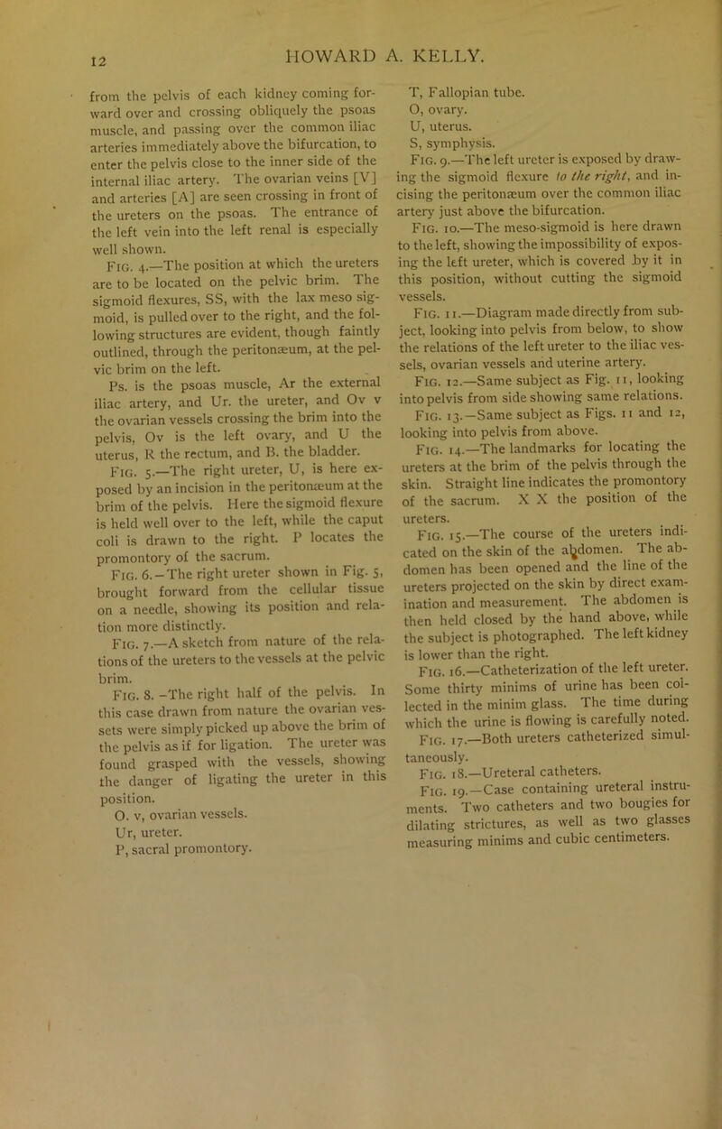 from the pelvis of each kidney coming for- ward over and crossing obliquely the psoas muscle, and passing over the common iliac arteries immediately above the bifurcation, to enter the pelvis close to the inner side of the internal iliac artery. The ovarian veins [V] and arteries [A] are seen crossing in front of the ureters on the psoas. The entrance of the left vein into the left renal is especially well shown. Fig. 4.—The position at which the ureters are to be located on the pelvic brim. The sigmoid flexures, SS, with the lax meso sig- moid, is pulled over to the right, and the fol- lowing structures are evident, though faintly outlined, through the peritonEeum, at the pel- vic brim on the left. Ps. is the psoas muscle, Ar the external iliac artery, and Ur. the ureter, and Ov v the ovarian vessels crossing the brim into the pelvis, Ov is the left ovary, and U the uterus, R the rectum, and B. the bladder. Fig. 5.—The right ureter, U, is here ex- posed by an incision in the peritonieum at the brim of the pelvis. Here the sigmoid flexure is held well over to the left, while the caput coli is drawn to the right. P locates the promontory of the sacrum. Fig. 6.-The right ureter shown in Fig. 5, brought forward from the cellular tissue on a needle, showing its position and rela- tion more distinctly. Fig. 7.—A sketch from nature of the rela- tions of the ureters to the vessels at the pelvic brim. Fig. 8. -The right half of the pelvis. In this case drawn from nature the ovarian ves- sets were simply picked up above the brim of the pelvis as if for ligation. I he ureter was found grasped with the vessels, showing the danger of ligating the ureter in this position. O. v, ovarian vessels. Ur, ureter. P, sacral promontory. T, Fallopian tube. O, ovary. U, uterus. S, symphysis. Fig. 9.—The left ureter is exposed by draw- ing the sigmoid flexure lo the right, and in- cising the peritonaeum over the common iliac artery just above the bifurcation. Fig. 10.—The meso-sigmoid is here drawn to the left, showing the impossibility of expos- ing the left ureter, which is covered by it in this position, without cutting the sigmoid vessels. Fig. 11.—Diagram made directly from sub- ject, looking into pelvis from below, to show the relations of the left ureter to the iliac ves- sels, ovarian vessels and uterine artery. Fig. 12.—Same subject as Fig. 11, looking into pelvis from side showing same relations. Fig. 13.—Same subject as Figs. 11 and 12, looking into pelvis from above. Fig. 14.—The landmarks for locating the ureters at the brim of the pelvis through the skin. Straight line indicates the promontory of the sacrum. X X the position of the ureters. Fig. 15.—'The course of the ureters indi- cated on the skin of the abdomen. '1 he ab- domen has been opened and the line of the ureters projected on the skin by direct exam- ination and measurement. The abdomen is then held closed by the hand above, while the subject is photographed. The left kidney is lower than the right. Fig. 16.—Catheterization of the left ureter. Some thirty minims of urine has been col- lected in the minim glass, the time during which the urine is flowing is carefully noted. Fig. 17.—Both ureters catheterized simul- taneously. Fig. 18.—Ureteral catheters. pIG> ,g _Case containing ureteral instru- ments. Two catheters and two bougies for dilating strictures, as well as two glasses measuring minims and cubic centimeters.