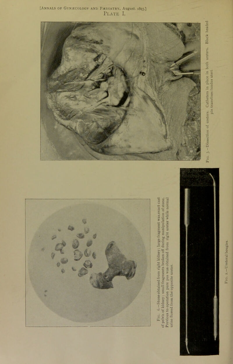 [Annals of Gynaecology and Paf.dtatrv, August. 1S93.] Plate I.