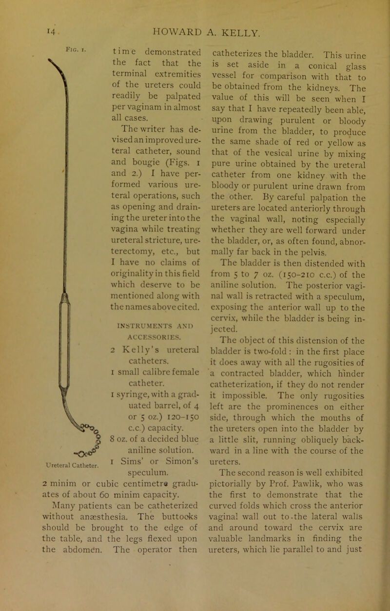 Fig. j. time demonstrated the fact that the terminal extremities of the ureters could readily be palpated per vaginam in almost all cases. The writer has de- vised an improved ure- teral catheter, sound and bougie (Figs, i and 2.) I have per- formed various ure- teral operations, such as opening and drain- ing the ureter into the vagina while treating ureteral stricture, ure- terectomy, etc., but I have no claims of originality in this field which deserve to be mentioned along with the names above cited. INSTRUMENTS AND ACCESSORIES. 2 Kelly’s ureteral catheters. i small calibre female catheter. i syringe, with a grad- uated barrel, of 4 or 5 oz.) 120-150 c.c.) capacity. 8 oz. of a decided blue aniline solution. 1 Sims’ or Simon’s speculum. 2 minim or cubic centimetre gradu- ates of about 60 minim capacity. Many patients can be catheterized without anaesthesia. The buttocks should be brought to the edge of the table, and the legs flexed upon the abdomdn. The operator then catheterizes the bladder. This urine is set aside in a conical glass vessel for comparison with that to be obtained from the kidneys. The value of this will be seen when I say that I have repeatedly been able, upon drawing purulent or bloody urine from the bladder, to produce the same shade of red or yellow as that of the vesical urine by mixing pure urine obtained by the ureteral catheter from one kidney with the bloody or purulent urine drawn from the other. By careful palpation the ureters are located anteriorly through the vaginal wall, noting especially whether they are well forward under the bladder, or, as often found, abnor- mally far back in the pelvis. The bladder is then distended with from 5 to 7 oz. (150-210 c.c.) of the aniline solution. The posterior vagi- nal wall is retracted with a speculum, exposing the anterior wall up to the cervix, while the bladder is being in- jected. The object of this distension of the bladder is two-fold : in the first place it does away with all the rugosities of a contracted bladder, which hinder catheterization, if they do not render it impossible. The only rugosities left are the prominences on either side, through which the mouths of the ureters open into the bladder by a little slit, running obliquely back- ward in a line with the course of the ureters. The second reason is well exhibited pictorially by Prof. Pawlik, who was the first to demonstrate that the curved folds which cross the anterior vagina! wall out to-the lateral walls and around toward the cervix are valuable landmarks in finding the ureters, which lie parallel to and just