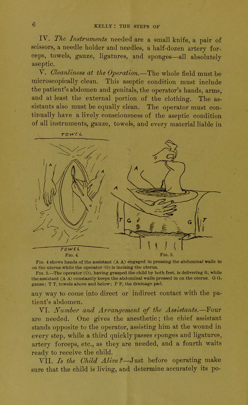 IV. The Instruments needed are a small knife, a pair of scissors, a needle holder and needles, a half-dozen artery for- ceps, towels, gauze, ligatures, and sponges—all absolutely aseptic. V. Cleanliness at the Operation.—The whole field must he microscopically clean. This aseptic condition must include the patient’s abdomen and genitals, the operator’s hands, arms, and at least the external portion of the clothing. The as- sistants also must be equally clean. The operator must con- tinually have a lively consciousness of the aseptic condition of all instruments, gauze, towels, and every material liable in TO we l. on the uterus while the operator <0) is incising the uterus. Fig. 5.—The operator (0), having grasped the child by both feet, is delivering it, while the assistant (A A! constantly keeps the abdominal walls pressed in on the uterus. G G, gauze; T T, towels above and below; P P, the drainage pad. any way to come into direct or indirect contact with the pa- tient’s abdomen. VI. Number and Arrangement of th,e Assistants.—Four are needed. One gives the anesthetic; the chief assistant stands opposite to the operator, assisting him at the wound in every step, while a third quickly passes sponges and ligatures, artery forceps, etc., as they are needed, and a fourth waits ready to receive the child. VII. Is the Child Alive?—Just before operating make sure that the child is living, and determine accurately its po-