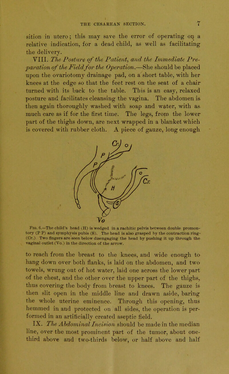 sition in utero; this may save the error of operating op a relative indication, for a dead child, as well as facilitating the delivery. VIII. The Posture of the Patient, and the Immediate Pre- paration of the Field for the Operation.—She slionld be placed upon the ovariotomy drainage pad, on a short table, with her knees at the edge so that the feet rest on the seat of a chair turned with its back to the table. This is an easy, relaxed posture and facilitates cleansing the vagina. The abdomen is then again thoroughly washed with soap and water, with as much care as if for the first time. The legs, from the lower part of the thighs down, are next wrapped in a blanket which is covered with rubber cloth. A piece of gauze, long enough Fig. 6.—The child’s head (H) is wedged in a rachitic pelvis between double promon- tory (P P) and symphysis pubis (S). The head is also grasped by the contraction ring- (Cr.) Two fingers are seen below disengaging the head by pushing it up through the vaginal outlet CVo.) in the direction of the arrow. to reach from the breast to the knees, and wide enough to hang down over both flanks, is laid on the abdomen, and two towels, wrung out of hot water, laid one across the lower part of the chest, and the other over the upper part of the thighs,, thus covering the body from breast to knees. The gauze is then slit open in the middle line and drawn aside, baring the whole uterine eminence. Through this opening, thus hemmed in and protected on all sides, the operation is per- formed in an artificially created aseptic field. IX. Tice Abdominal Incision should be made in the median line, over the most prominent part of the tumor, about one- third above and two-thirds below, or half above and half