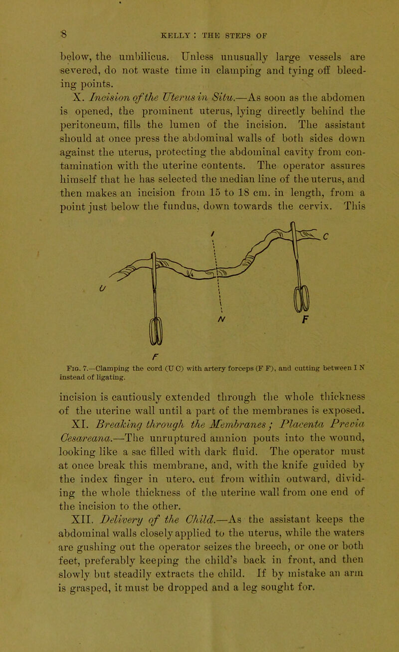 below, the umbilicus. Unless unusually large vessels are severed, do not waste time in clamping and tying off bleed- ing points. X. Incision of the TJterus in Situ.—As soon as the abdomen is opened, the prominent uterus, lying directly behind the peritoneum, tills the lumen of the incision. The assistant should at once press the abdominal walls of both sides down against the uterus, protecting the abdominal cavity from con- tamination with the uterine contents. The operator assures himself that he has selected the median line of the uterus, and then makes an incision from 15 to 18 cm. in length, from a point just below the fundus, down towards the cervix. This Fig. 7.—Clamping the cord (U C) with artery forceps (F F). and cutting between I N instead of ligating. incision is cautiously extended through the whole thickness of the uterine wall until a part of the membranes is exposed. XI. Breaking through the Membranes / Placenta Preoia Cesareana.—The unruptured amniou pouts into the wound, looking like a sac filled with dark fluid. The operator must at once break this membrane, and, with the knife guided by the index finger in utero, cut from within outward, divid- ing the whole thickness of the uterine wall from one end of the incision to the other. XII. Delivery of the Child.—As the assistant keeps the abdominal walls closely applied to the uterus, while the waters are gushing out the operator seizes the breech, or one or both feet, preferably keeping the child’s back in front, and then slowly but steadily extracts the child. If by mistake an arm is grasped, it must be dropped and a leg sought for.