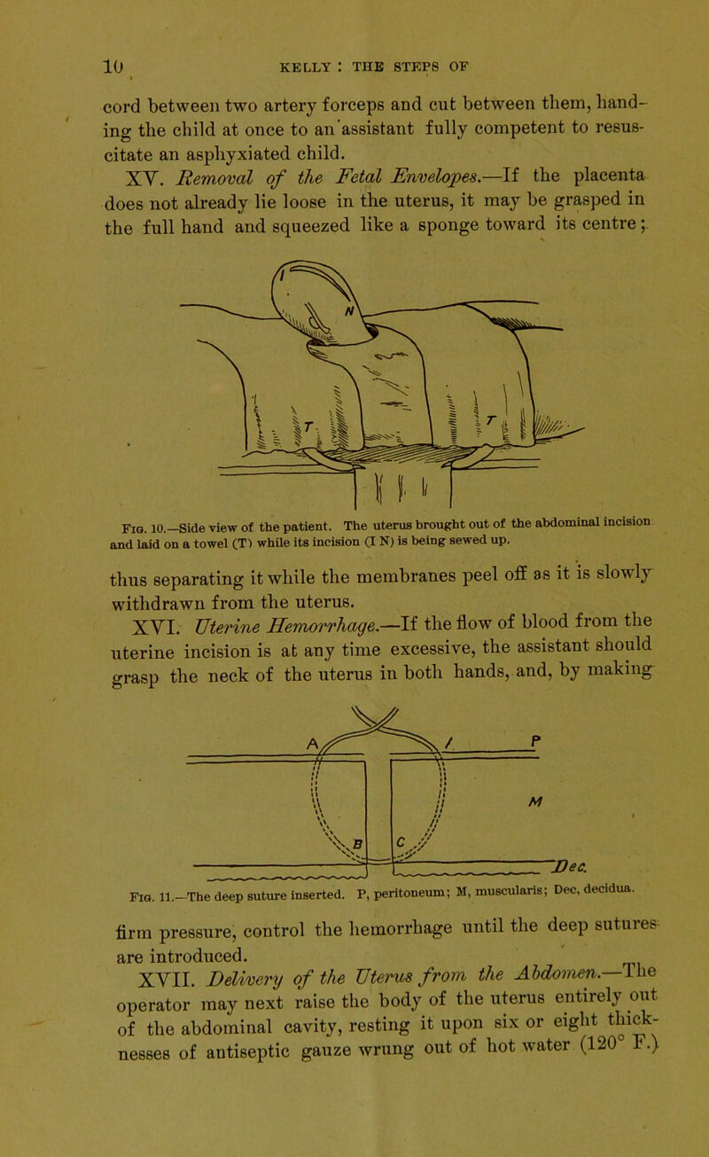 cord between two artery forceps and cut between them, hand- ing the child at ouce to an'assistant fully competent to resus- citate an asphyxiated child. XV. Removal of the Fetal Envelopes.—If the placenta does not already lie loose in the uterus, it may be grasped in the full hand and squeezed like a sponge toward its centre; Fig. 10.—Side view of the patient. The uterus brought out of the abdominal incision and laid on a towel (T1 while its incision (I N) is being sewed up. thus separating it while the membranes peel off as it is slowly withdrawn from the uterus. XVI. Uterine Hemorrhage.—If the flow of blood from the uterine incision is at any time excessive, the assistant should grasp the neck of the uterus in both hands, and, by making firm pressure, control the hemorrhage until the deep sutures are introduced. XVII. Delivery of the Uterus from the Abdomen.—The operator may next raise the body of the uterus entirely out of the abdominal cavity, resting it upon six or eight thick- nesses of antiseptic gauze wrung out of hot water (120 F.)