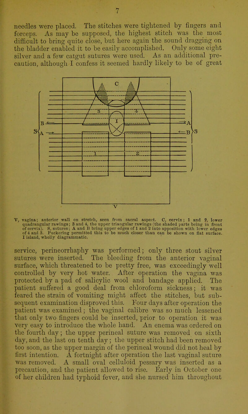 needles were placed. The stitches were tightened by fingers and forceps. As may be supposed, the highest stitch was the most difficult to bring quite close, but here again the sound dragging on the bladder enabled it to be easily accomplished. Only some eight silver and a few catgut sutures were used. As an additional pre- caution, although I confess it seemed hardly likely to be of great V, vagina; anterior wall on stretch, seen from sacral aspect. C, cervix; 1 and 2, lower quadrangular rawings; 3 and 4, the upper triangular rowings (the shaded parts being in front of cervix). S, sutures; A and B bring upper edges of 1 and 2 into apposition with lower edges of 4 and 3. Puckering permitted this to be much closer than can be shown on flat surface. I island, wholly diagrammatic. service, perineorrhaphy was performed; only three stout silver sutures were inserted. The bleeding from the anterior vaginal surface, which threatened to be pretty free, was exceedingly well controlled by very hot water. After operation the vagina was protected by a pad of salicylic wool and bandage applied. The patient suffered a good deal from chloroform sickness; it was feared the strain of vomiting might affect the stitches, but sub- sequent examination disproved this. Tour days after operation the patient was examined ; the vaginal calibre was so much lessened that only two fingers could be inserted, prior to operation it was very easy to introduce the whole hand. An enema was ordered on the fourth day; the upper perineal suture was removed on sixth day, and the last on tenth day; the upper stitch had been removed too soon, as the upper margin of the perineal wound did not heal by first intention. A fortnight after operation the last vaginal suture was removed. A small oval celluloid pessary was inserted as a precaution, and the patient allowed to rise. Early in October one of her children had typhoid fever, and she nursed him throughout