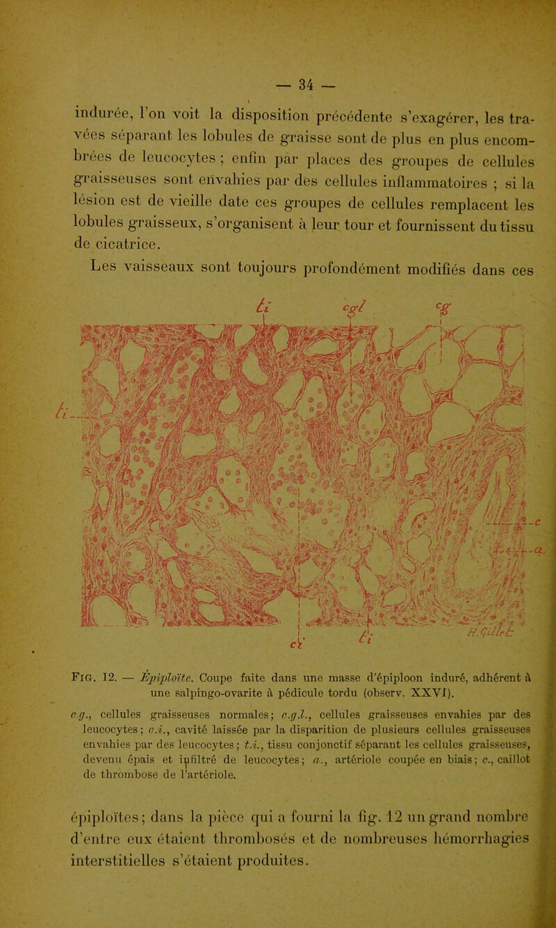 i indurée, 1 on voit la disposition précédente s’exagérer, les tra- vées séparant les lobules de graisse sont de plus en plus encom- brées de leucocytes ; enfin par places des groupes de cellules graisseuses sont envahies par des cellules inflammatoires ; si la lésion est de vieille date ces groupes de cellules remplacent les lobules graisseux, s’organisent à leur tour et fournissent du tissu de cicatrice. Les vaisseaux sont toujours profondément modifiés dans ces tl Co-l cg Fig. 12. — Êpiploïtc. Coupe faite dans une niasse d’épiploon induré, adhérent i\ une salpingo-ovarite à pédicule tordu (observ. XXVI). ci/., cellules graisseuses normales; c.g.l., cellules graisseuses envahies par des leucocytes; c:L, cavité laissée par la disparition de plusieurs cellules graisseuses envahies par des leucocytes; t.i., tissu conjonctif séparant les cellules graisseuses, devenu épais et infiltré de leucocytes; a., artériole coupée en biais; c., caillot de thrombose de l’artériole. épiploïtcs; dans la pièce qui a fourni la fig. 12 un grand nombre d’entre eux étaient thrombosés et de nombreuses hémorrhagies interstitielles s’étaient produites.