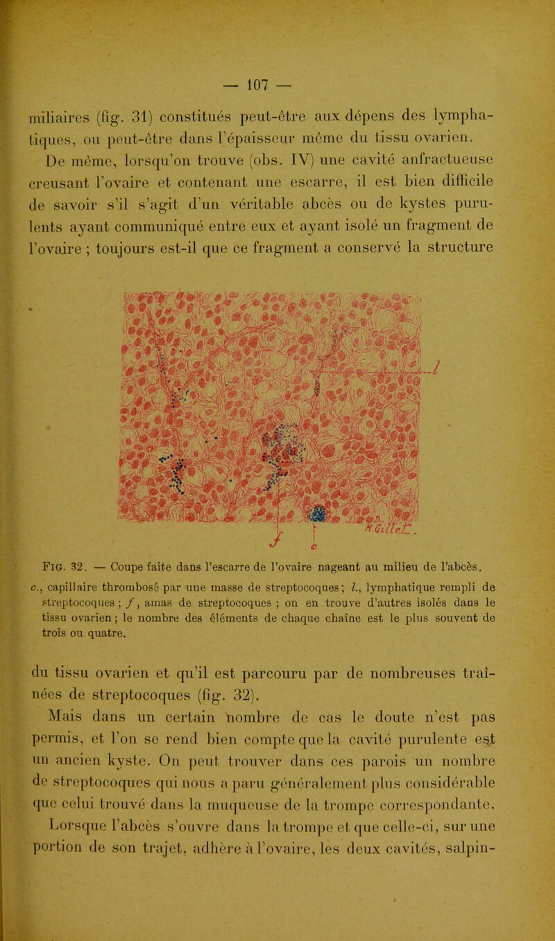 miliaires (fîg. 31) constitués peut-être aux dépens des lympha- tiques, ou peut-être dans l’épaisseur même du tissu ovarien. De même, lorsqu’on trouve (obs. 1Y) une cavité anfractueuse creusant l’ovaire et contenant une escarre, il est bien difficile de savoir s’il s’agit d’un véritable abcès ou de kystes puru- lents ayant communiqué entre eux et ayant isolé un fragment de l’ovaire ; toujours est-il que ce fragment a conservé la structure Fig. 32. — Coupe faite dans l’escarre de l’ovaire nageant au milieu de l’abcès. o., capillaire thrombosé par une masse de streptocoques; l., lymphatique rempli de streptocoques; f, amas de streptocoques ; on en trouve d’autres isolés dans le tissu ovarien ; le nombre des éléments de chaque chaîne est le plus souvent de trois ou quatre. du tissu ovarien et qu’il est parcouru par de nombreuses traî- nées de streptocoques (fîg. 32). Mais dans un certain 'nombre de cas le doute n’est pas permis, et l’on se rend bien compte que la cavité purulente e$.t un ancien kyste. On peut trouver dans ces parois un nombre de streptocoques qui nous a paru généralement plus considérable que celui trouvé dans la muqueuse de la trompe correspondante. Lorsque l’abcès s’ouvre dans la trompe et que celle-ci, sur une portion de son trajet, adhère à l’ovaire, les deux cavités, salpin-