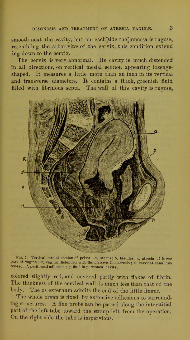 smooth next the cavity, but on eacirside the^mueosa is rugose, resembling the arbor vitm of the cervix, this condition extend ing down to the cervix. The cervix is very abnormal. Its cavity is much distended in all directions, on vertical mesial section appearing lozenge- shaped. It measures a little more than an inch in its vertical and transverse diameters. It contains a thick, greenish fluid filled with fibrinous septa. The wall of this cavity is rugose. Fig. 1.—Vertical mesial section of pelvis, a, uterus; b, bladder; c, atresia of lower part of vagina; d, vagina distended with fluid above the atresia; e, cervical canal dis- tended ; /, peritoneal adhesion ; g, fluid in peritoneal cavity. colored slightly red, and covered partly with flakes of fibrin. The thickness of the cervical wall is much less than that of the body. The os externum admits the end of the little finger. The whole organ is fixed by extensive adhesions to surround- ing structures. A fine probe can be passed along the interstitial part of the left tube toward the stump left from the operation. On the right side the tube is impervious.