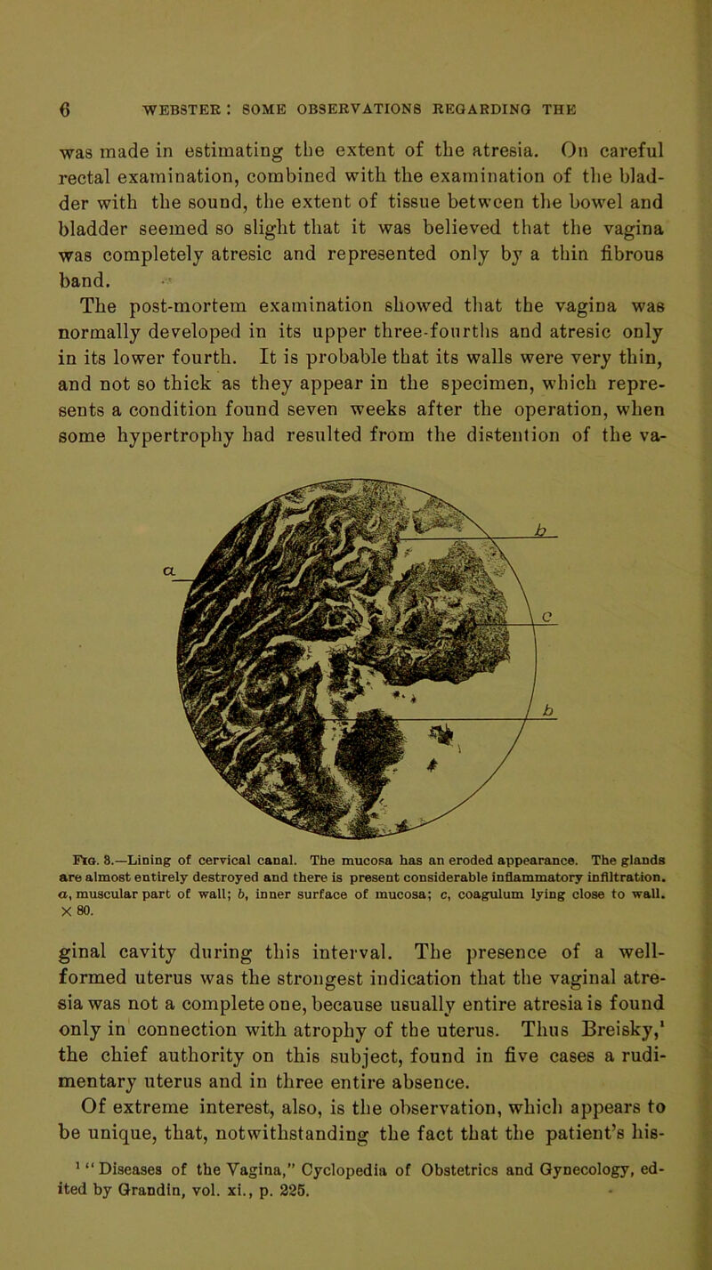 was made in estimating the extent of the atresia. On careful rectal examination, combined with the examination of the blad- der with the sound, the extent of tissue between the bowel and bladder seemed so slight that it was believed that the vagina was completely atresic and represented only by a thin fibrous band. •' The post-mortem examination showed that the vagina was normally developed in its upper three-fourths and atresic only in its lower fourth. It is probable that its walls were very thin, and not so thick as they appear in the specimen, which repre- sents a condition found seven weeks after the operation, when some hypertrophy had resulted from the distention of the va- Fia. 8.—Lining of cervical canal. The mucosa has an eroded appearance. The glands are almost entirely destroyed and there is present considerable inflammatory infiltration, a, muscular part of wall; b, inner surface of mucosa; c, coagulum lying close to wall. X 80. ginal cavity during this interval. The presence of a well- formed uterus was the strongest indication that the vaginal atre- sia was not a complete one, because usually entire atresia is found only in connection with atrophy of the uterus. Thus Breisky,‘ the chief authority on this subject, found in five cases a rudi- mentary uterus and in three entire absence. Of extreme interest, also, is the observation, which appears to be unique, that, notwithstanding the fact that the patient’s his- * “Diseases of the Vagina,” Cyclopedia of Obstetrics and Gynecology, ed- ited by Qrandin, vol. xi., p. 226.