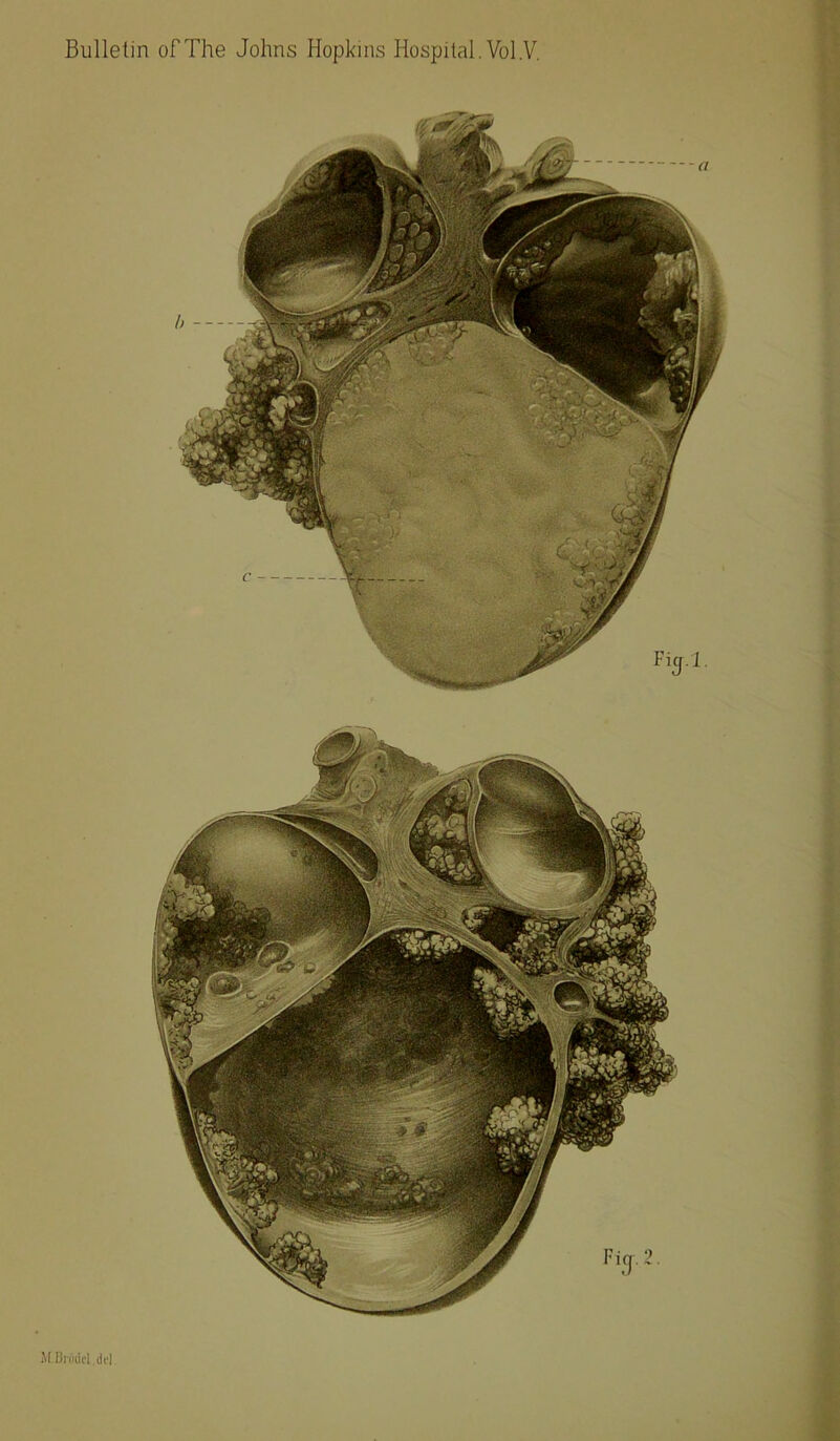 Bulletin of The Johns Hopkins Hospital. Vol.V. M Briiilcl.dt'l