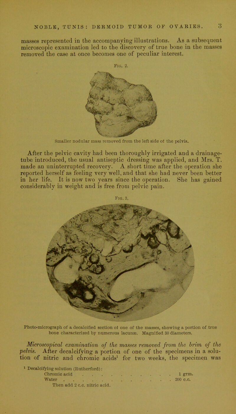 Then add 2 c.c. nitric acid. masses represented in the accompanying illustrations. As a subsequent microscopic examination led to the discovery of true bone in the masses removed the case at once becomes one of peculiar interest. Fig. 2. Smaller nodular mass removed from the left side of the pelvis. After the pelvic cavity had been thoroughly irrigated and a drainage- tube introduced, the usual antiseptic dressing was applied, and Mrs. T. made an uninterrupted recovery. A short time after the operation she reported herself as feeling very well, and that she had never been better in her life. It is now two years since the operation. She has gained considerably in weight and is free from pelvic pain. fig. 3. Microscopical examination of the masses removed from the brim of the pelvis. After decalcifying a portion of one of the specimens in a solu- tion of nitric and chromic acids1 for two weeks, the specimen was 1 Decalcifying solution (Rutherford): Chromic acid 1 grm. Water 200 c.c. Photo-micrograph of a decalcified section of one of the masses, showing a portion of true bone characterized by numerous lacunse. Magnified 30 diameters.