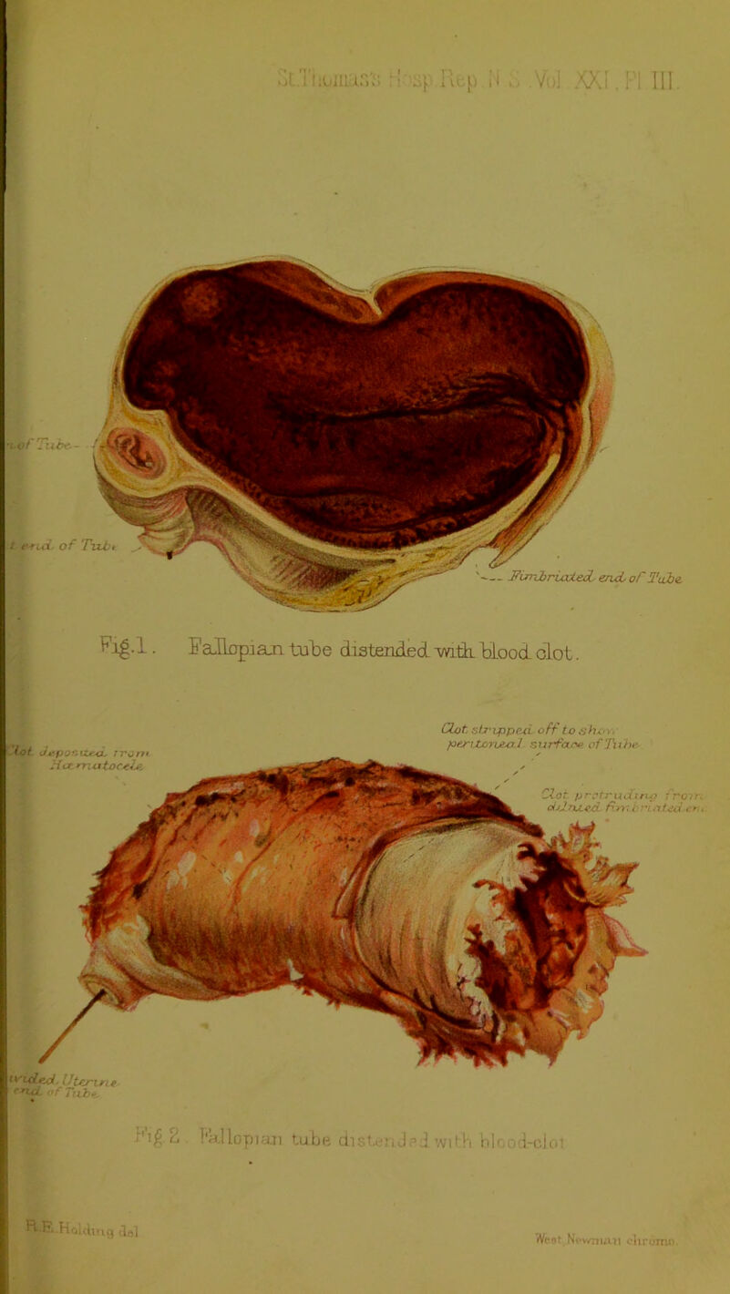 ot.Thomas's ^osp.Rep N Vo] XXI,PI III. ^Tg.l • Falkrpian tube distended with, blood olot. Clot, stropped off to shot. lot depor. izro. : j'j rr* Her rn a tootle. peritoneal surface of Tube, Clot protruding from. ctjjnued flmij rioted tou U'idled Uterine end. of Ttx.be, ■ ’i£ t> 1‘a.llopian tube distendedwith b|r,od-cJoi BiE Holding del