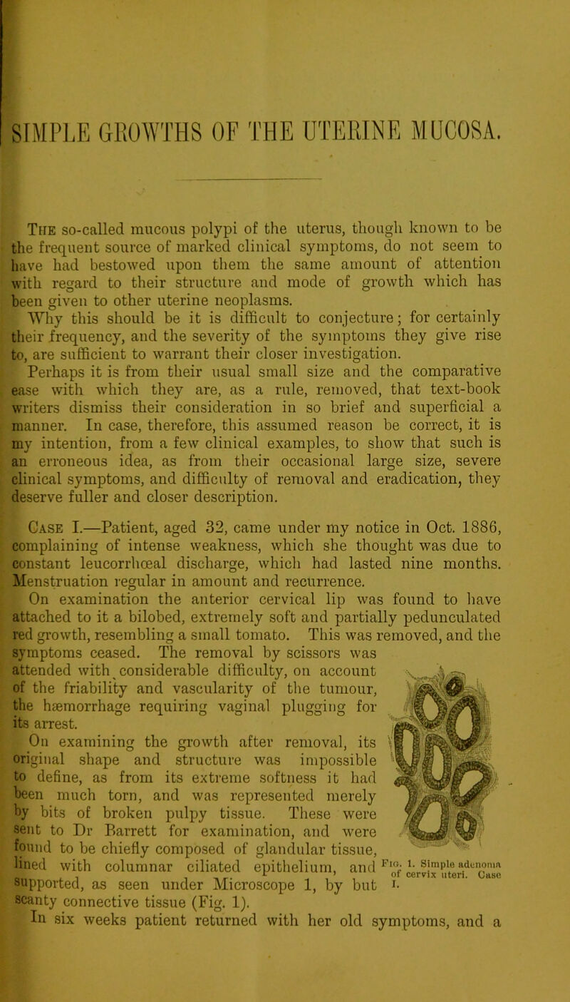 The so-called raucous polypi of the uterus, though known to be the frequent source of marked clinical symptoms, do not seem to liave had bestowed upon them the same amount of attention with regard to their structure and mode of growth which has been given to other uterine neoplasms. Why this should be it is difficult to conjecture; for certainly their frequency, and the severity of the symptoms they give rise to, are sufficient to warrant their closer investigation. Perhaps it is from their usual small size and the comparative ease with which they are, as a rule, removed, that text-book writers dismiss their consideration in so brief and superficial a manner. In case, therefore, this assumed reason be correct, it is my intention, from a few clinical examples, to show that such is an erroneous idea, as from their occasional large size, severe clinical symptoms, and difficulty of removal and eradication, they deserve fuller and closer description. Case I.—Patient, aged 32, came under my notice in Oct. 1886, complaining of intense weakness, which she thought was due to constant leucorrhoeal discharge, which had lasted nine months. Menstruation regular in amount and recurrence. On examination the anterior cervical lip was found to liave attached to it a bilobed, extremely soft and partially pedunculated red growth, resembling a small tomato. This was removed, and the symptoms ceased. The removal by scissors was attended with considerable difficulty, on account of the friability and vascularity of the tumour, the haemorrhage requiring vaginal plugging for its arrest. On examining the growth after removal, its original shape and structure was impossible to define, as from its extreme softness it had been much torn, and was represented merely by bits of broken pulpy tissue. These were sent to Dr Barrett for examination, and were found to be chiefly composed of glandular tissue, lined with columnar ciliated epithelium, and supported, as seen under Microscope 1, by but i- scanty connective tissue (Fig. 1). In six weeks patient returned with her old symptoms, and a