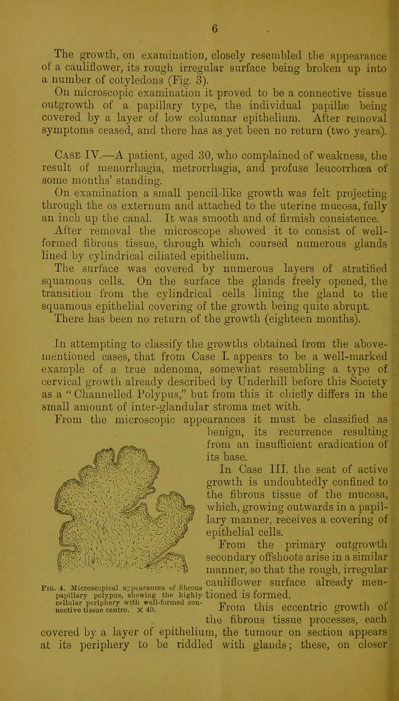 The growth, on examination, closely resembled the appearance of a cauliflower, its rough irregular surface being broken up into a number of cotyledons (Fig. 3). On microscopic examination it proved to be a connective tissue outgrowth of a papillary type, the individual papillae being covered by a layer of low columnar epithelium. After removal symptoms ceased, and there has as yet been no return (two years). Case IV.—A patient, aged 30, who complained of weakness, the result of menorrhagia, metrorrhagia, and profuse leucorrhoea of some months’ standing. On examination a small pencil-like growth was felt projecting through the os externum and attached to the uterine mucosa, fully an inch up the canal. It was smooth and of firmish consistence. After removal the microscope showed it to consist of well- formed fibrous tissue, through which coursed numerous glands lined by cylindrical ciliated epithelium. The surface was covered by numerous layers of stratified squamous cells. On the surface the glands freely opened, the transition from the cylindrical cells lining the gland to the squamous epithelial covering of the growth being quite abrupt. There has been no return of the growth (eighteen months). In attempting to classify the growths obtained from the above- mentioned cases, that from Case I. appears to be a well-marked example of a true adenoma, somewhat resembling a type of cervical growth already described by Underhill before this Society as a “ Channelled Polypus,” but from this it chiefly differs in the small amount of inter-glandular stroma met with. From the microscopic appearances it must be classified as benign, its recurrence resulting from an insufficient eradication of its base. In Case III. the seat of active growth is undoubtedly confined to the fibrous tissue of the mucosa, which, growing outwards in a papil- lary manner, receives a covering of epithelial cells. From the primary outgrowth secondary offshoots arise in a similar manner, so that the rough, irregular ^ cauliflower surface already men- Fig. 4. Microscopical apiiearauces of norous • j • p •, *' papillary polypus, showing the highly tlOlied IS foi’llied. cellular periphery with well-formed con- , ii nective tissue centre. X 40. Fl'Om this eCCeutlic grO^^ til Ol the fibrous tissue processes, each covered by a layer of epithelium, the tumour on section appears at its periphery to be riddled with glands; these, on closer