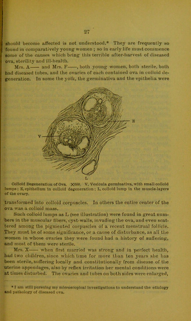 should become affected is not understood.* They are frequently so found in comparatively young women ; so in early life must commence some of the causes which bring this terrible after-harvest of diseased ova, sterility and ill-health. Mrs. A and Mrs. F , both young women, both sterile, both had diseased tubes, and the ovaries of each contained ova in colloid de- generation. In some the yolk, the germinativa and the epithelia were L Colloid Degeneration of Ova. X600. V, Vesicula germinativa, with small colloid lnmps; E, epithelium in colloid degeneration ; L, colloid lump in the muscle-layers of the ovary. transformed into colloid corpuscles. In others the entire center of the ova was a colloid mass. Such colloid lumps as L (see illustration) were found in great num- bers in the muscular libers, cyst-walls, invading ihe ova, and even scat- tered among the pigmented corpuscles of a recent menstrual follicle. They must be of some significance, or a cause of disturbance, as all the women in whose ovaries they were found had a history of suffering, and most of them were sterile. Mrs. X when first married was strong and in perfect health, had two children, since which time for more than ten years she has been sterile, suffering locally and constitutionally from disease of the uterine appendages, also by reflex irritation her mental conditions were at times disturbed. The ovaries and tubes on both sides were enlarged, * I am still pursuing my microscopical investigations to understand the etiology and pathology of diseased ova.