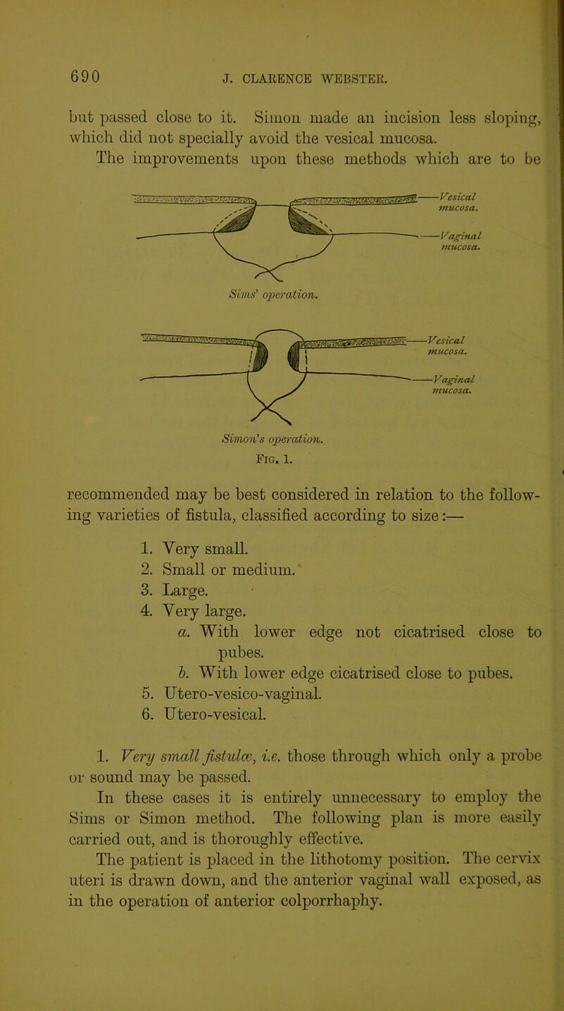 but passed close to it. Simon made an incision less sloping, which did not specially avoid the vesical mucosa. The improvements upon these methods which are to be Fig. 1. recommended may be best considered in relation to the follow- ing varieties of fistula, classified according to size:— 1. Very small. 2. Small or medium. 3. Large. 4. Very large. a. With lower edge not cicatrised close to pubes. h. With lower edge cicatrised close to pubes. 5. Utero-vesico-vaginal. 6. Utero-vesical. 1. Very small fistula;, i.e. those through which only a probe or sound may be passed. In these cases it is entirely unnecessary to employ the Sims or Simon method. The following plan is more easily carried out, and is thoroughly effective. The patient is placed in the lithotomy position. The cervix uteri is drawn down, and the anterior vaginal wall exposed, as in the operation of anterior colporrhaphy.