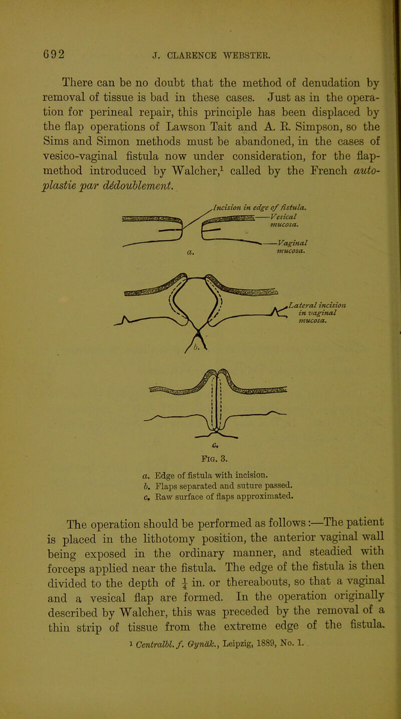 There can be no doubt that the method of denudation by removal of tissue is bad in these cases. Just as in the opera- tion for perineal repair, this principle has been displaced by the flap operations of Lawson Tait and A. E. Simpson, so the Sims and Simon methods must be abandoned, in the cases of vesico-vaginal fistula now under consideration, for the flap- method introduced by Walcher,1 called by the French auto- plastie par cUcloublemmt. Incision in edge of fistula. —Vesical mucosa. - Vaginal mucosa. a. Edge of fistula with incision. b. Flaps separated and suture passed. c. Raw surface of flaps approximated. The operation should be performed as follows:—The patient is placed in the lithotomy position, the anterior vaginal wall being exposed in the ordinary manner, and steadied with forceps applied near the fistula. The edge of the fistida is then divided to the depth of ^ in. or thereabouts, so that a vaginal and a vesical flap are formed. In the operation originally described by Walcher, this was preceded by the removal of a thin strip of tissue from the extreme edge of the fistula. i Centralbl.f. Oyndk., Leipzig, 1889, No. 1.