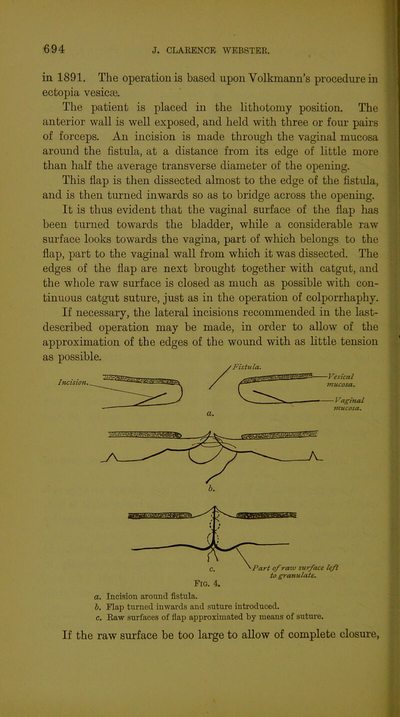 in 1891. The operation is based upon Volkmann’s procedure in ectopia vesicte. The patient is placed in the lithotomy position. The anterior wall is well exposed, and held with three or four pairs of forceps. An incision is made through the vaginal mucosa around the fistula, at a distance from its edge of little more than half the average transverse diameter of the opening. This flap is then dissected almost to the edge of the fistula, and is then turned inwards so as to bridge across the opening. It is thus evident that the vaginal surface of the flap has been turned towards the bladder, while a considerable raw surface looks towards the vagina, part of which belongs to the flap, part to the vaginal wall from which it was dissected. The edges of the flap are next brought together with catgut, and the whole raw surface is closed as much as possible with con- tinuous catgut suture, just as in the operation of colporrhaphy. If necessary, the lateral incisions recommended in the last- described operation may be made, in order to allow of the approximation of the edges of the wound with as little tension as possible. a. Incision around fistula. b. Flap turned inwards and suture introduced. c. Raw surfaces of flap approximated by means of suture. If the raw surface be too large to allow of complete closure,