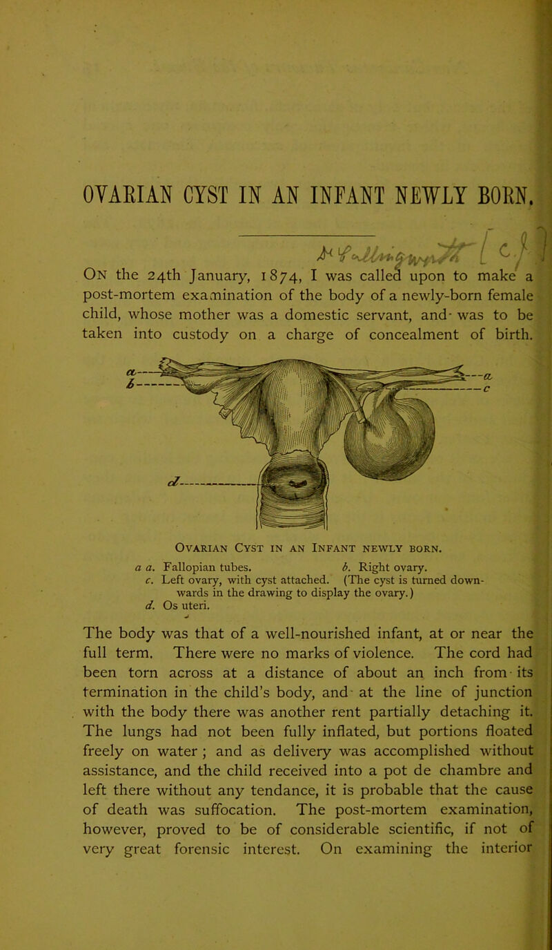 ON the 24th January, 1874* ^ was ^.ancu up>uu LU iiiatvc a post-mortem examination of the body of a newly-born female child, whose mother was a domestic servant, and- was to be taken into custody on a charge of concealment of birth. The body was that of a well-nourished infant, at or near the full term. There were no marks of violence. The cord had been torn across at a distance of about an inch from - its termination in the child’s body, and at the line of junction with the body there was another rent partially detaching it. The lungs had not been fully inflated, but portions floated freely on water ; and as delivery was accomplished without assistance, and the child received into a pot de chambre and left there without any tendance, it is probable that the cause of death was suffocation. The post-mortem examination, however, proved to be of considerable scientific, if not of very great forensic interest. On examining the interior ■11 c Ovarian Cyst in an Infant newly born. a a. Fallopian tubes. b. Right ovary. c. Left ovary, with cyst attached. (The cyst is turned down- wards in the drawing to display the ovary.) d. Os uteri.