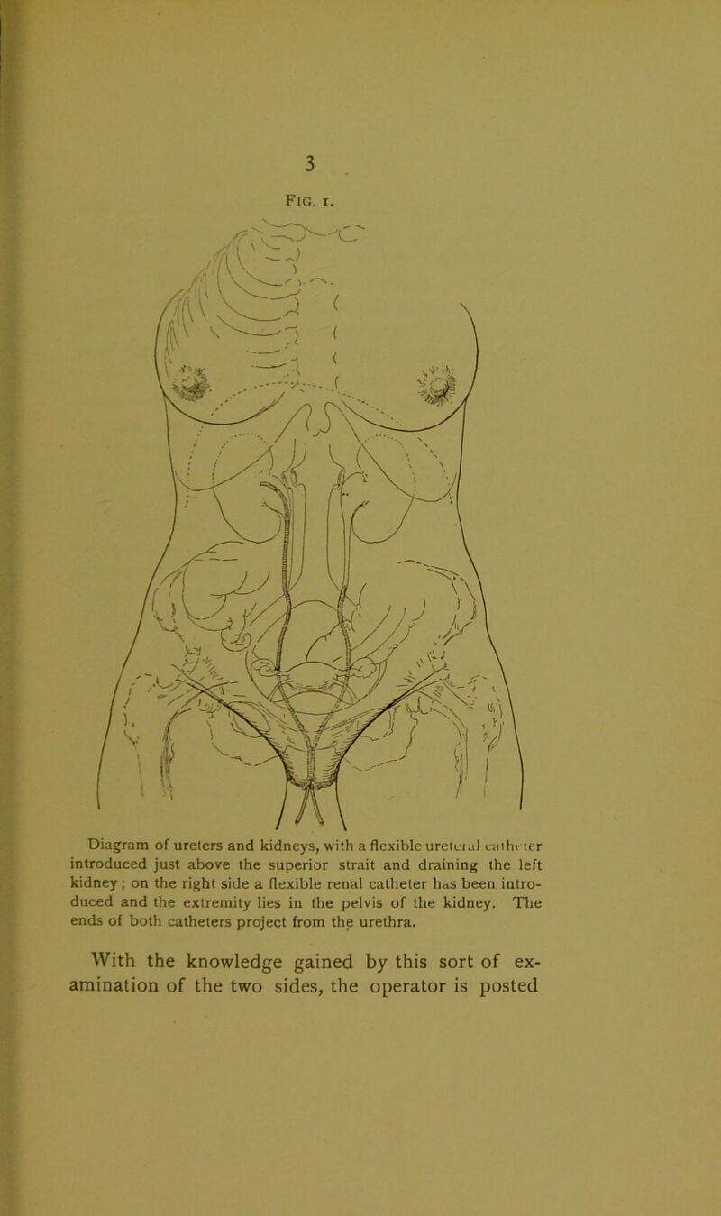 Fig. i. Diagram of ureters and kidneys, with a flexible ureteul catheter introduced just above the superior strait and draining the left kidney; on the right side a flexible renal catheter has been intro- duced and the extremity lies in the pelvis of the kidney. The ends of both catheters project from the urethra. With the knowledge gained by this sort of ex- amination of the two sides, the operator is posted