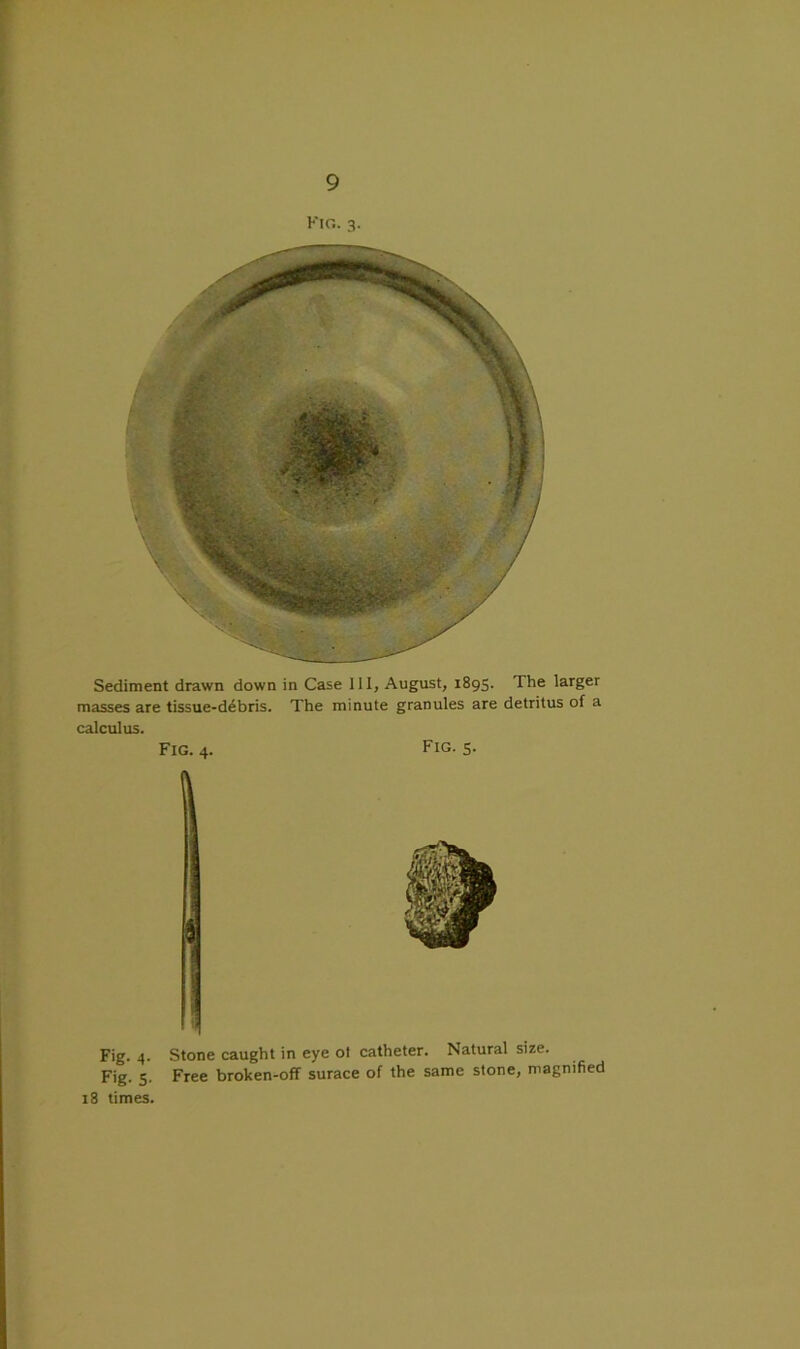 Kir.. 3. Sediment drawn down in Case III, August, 1895. The larger masses are tissue-debris. The minute granules are detritus of a calculus. Fig. 4. Fig. 5. \ Fig. 4. Stone caught in eye ot catheter. Natural size. Fig. 5. Free broken-off surace of the same stone, magnified 18 times.