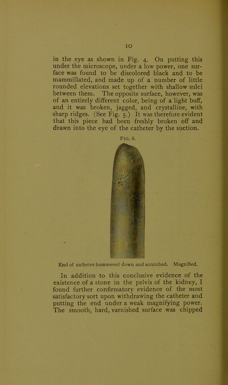 IO in the eye as shown in Fig. 4. On putting this under the microscope, under a low power, one sur- face was found to be discolored black and to be mammillated, and made up of a number of little rounded elevations set together with shallow sulci between them. The opposite surface, however, was of an entirely different color, being of a light buff, and it was broken, jagged, and crystalline, with sharp ridges. (See Fig. 5.) It was therefore evident that this piece had been freshly broken off and drawn into the eye of the catheter by the suction. Fig. 6. End of catheter hammered down and scratched. Magnified. In addition to this conclusive evidence of the existence of a stone in the pelvis of the kidney, I found further confirmatory evidence of the most satisfactory sort upon withdrawing the catheter and putting the end under a weak magnifying power. The smooth, hard, varnished surface was chipped