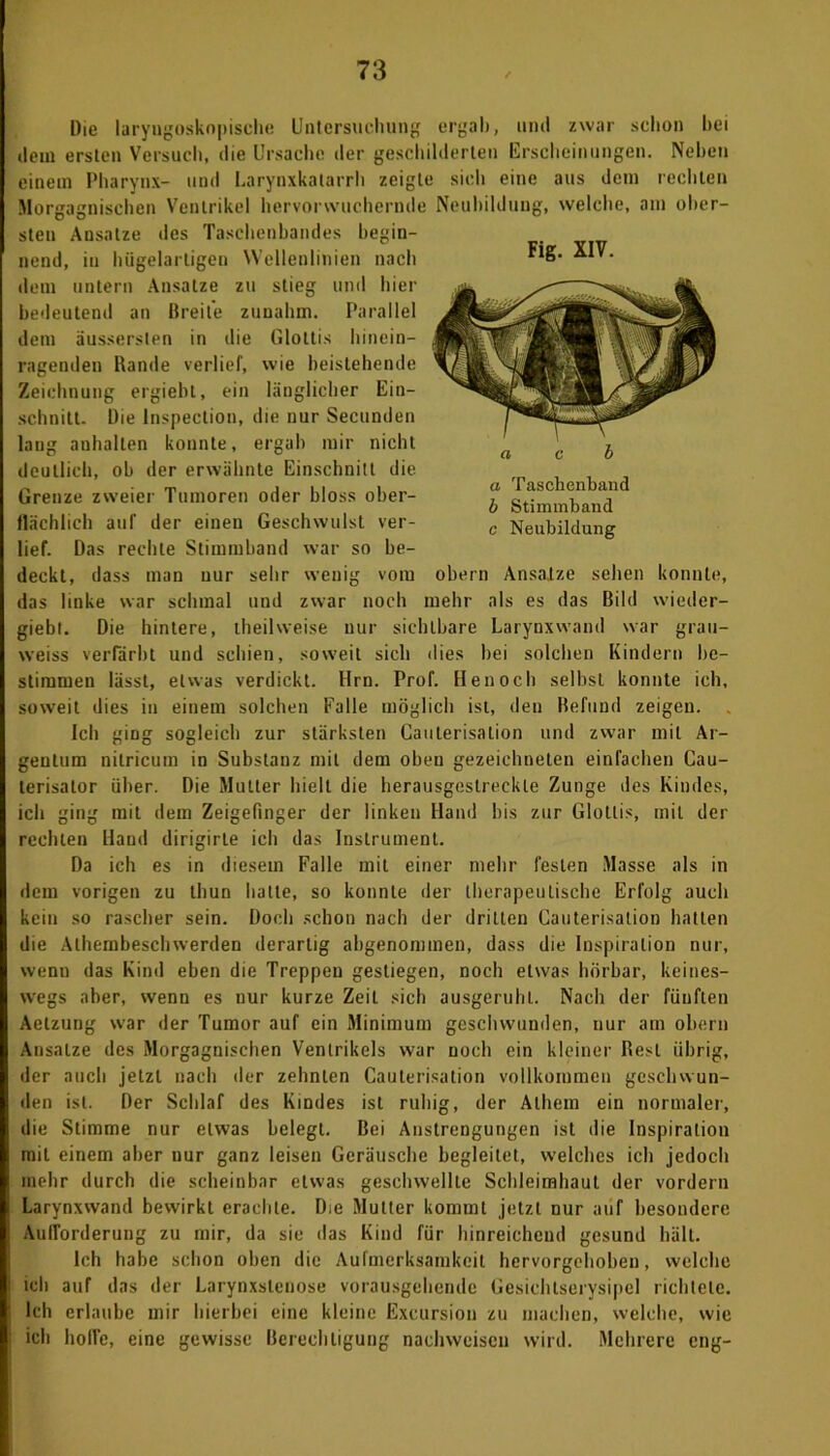 Fig. XIV. Die laryngoskopiselie Untersuchung ergab, und zwar schon hei dem ersten Versuch, die Ursache der geschilderten Erscheinungen. Neben einem Pharynx- und Larynxkatarrh zeigte sich eine aus dem rechten Morgagnisehen Ventrikel hervorwuchernde Neubildung, welche, am ober- sten Ansätze des Taschenbandes begin- nend, in hügelartigen Wellenlinien nach dem untern Ansätze zu stieg und hier bedeutend an Breite zunahm. Parallel dem äusserslen in die Glottis hinein- ragenden Bande verlief, wie beziehende Zeichnung ergiebt, ein länglicher Ein- schnitt. Die lnspection, die nur Secunden lang anhalten konnte, ergab mir nicht deutlich, ob der erwähnte Einschnitt die Grenze zweier Tumoren oder bloss ober- flächlich auf der einen Geschwulst ver- lief. Das rechte Stimmband war so be- deckt, dass man nur sehr wenig vom obern Ansätze sehen konnte, das linke war schmal und zwar noch mehr als es das Bild wieder- giebt. Die hintere, iheilweise nur sichtbare Larynxwand war grau- weiss verfärbt und schien, soweit sich dies bei solchen Kindern be- stimmen lässt, etwas verdickt. Hrn. Prof. Henoch selbst konnte ich, soweit dies in einem solchen Falle möglich ist, den Befund zeigen. Ich ging sogleich zur stärksten Caulerisalion und zwar mit Ar- gentum nilricum in Substanz mit dem oben gezeichneten einfachen Cau- terisalor über. Die Mutter hielt die herausgeslreckle Zunge des Kindes, ich ging mit dem Zeigefinger der linken Hand bis zur Glottis, mit der rechten Hand dirigirle ich das Instrument. a Taschenband b Stimmband c Neubildung Da ich es in diesem Falle mit einer mehr festen Masse als in dem vorigen zu thun hatte, so konnte der therapeutische Erfolg auch kein so rascher sein. Doch schon nach der dritten Cauterisation hatten die Athembeschwerden derartig abgenommen, dass die Inspiration nur, wenn das Kind eben die Treppen gestiegen, noch etwas hörbar, keines- wegs aber, wenn es nur kurze Zeit sich ausgeruht. Nach der fünften Aelzung war der Tumor auf ein Minimum geschwunden, nur am obern Ansätze des Morgagnischen Ventrikels war noch ein kleiner Best übrig, der auch jetzt nach der zehnten Cauterisation vollkommen geschwun- den ist. Der Schlaf des Kindes ist ruhig, der Alhem ein normaler, die Stimme nur etwas belegt. Bei Anstrengungen ist die Inspiration miL einem aber nur ganz leisen Geräusche begleitet, welches ich jedoch mehr durch die scheinbar etwas geschwellte Schleimhaut der vordem Larynxwand bewirkt erachte. Die Mutter kommt jetzt nur auf besondere Aufforderung zu mir, da sie das Kind für hinreichend gesund hält. Ich habe schon oben die Aufmerksamkeit hervorgchobeu, welche ich auf das der Larynxslenose vorausgehende Gesichlserysipel richtete. Ich erlaube mir hierbei eine kleine Excursiou zu machen, welche, wie ich hoffe, eine gewisse Berechtigung nachwciscn wird. Mehrere eng-