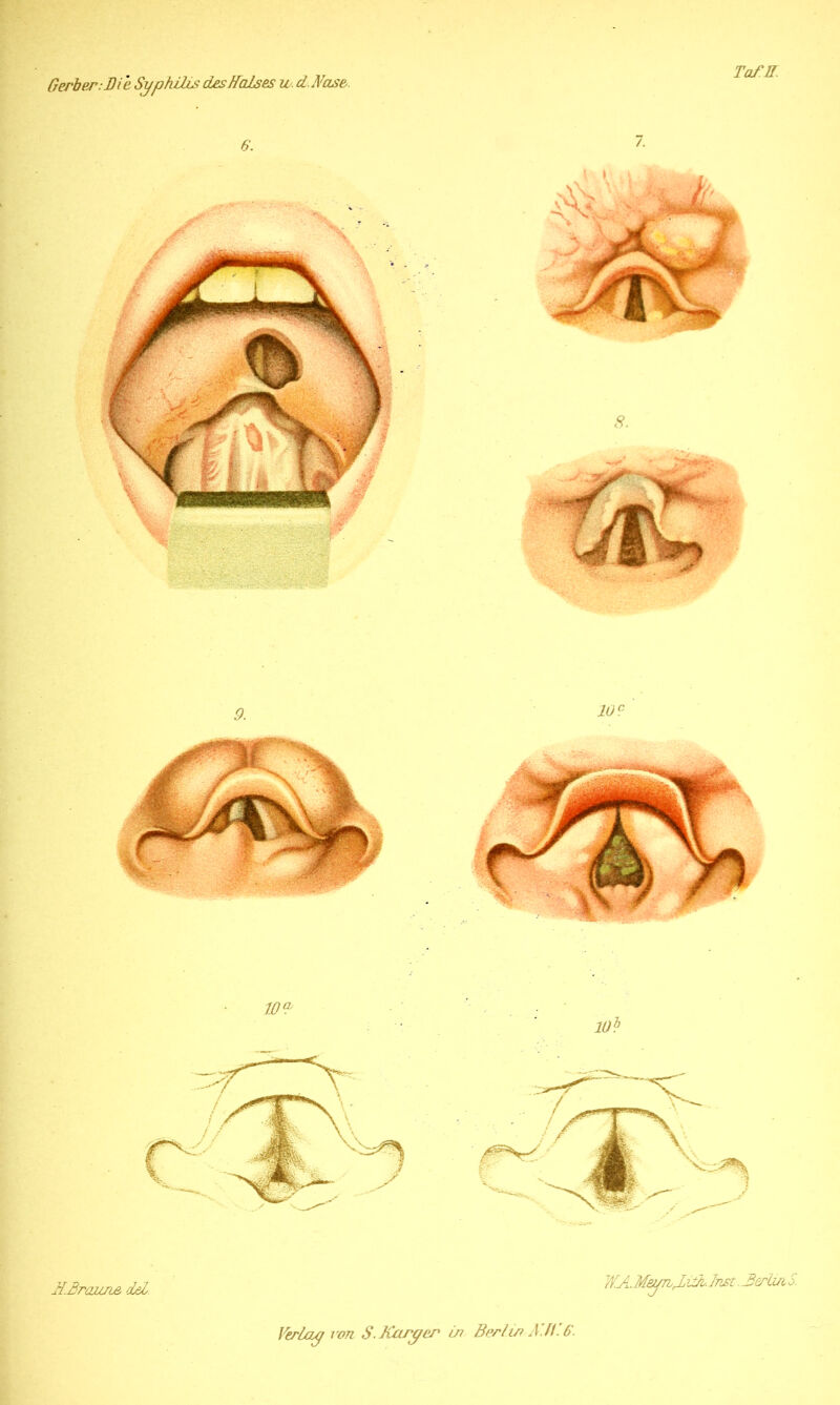 Tafff. Gerber: Die Syjohilis des Halses w. d.Nase. HBrazuie lei WA. MeynHdl. Inst. JSerlUi S.