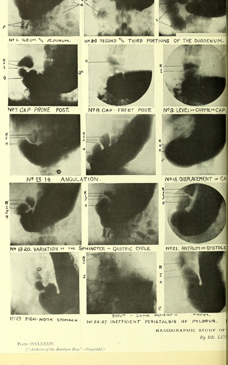 fiSh-hook stomach £F}EC“T- - SAME- ppyTtENT* — PROr>lt_ N® 2S-27. INEFFlClElNr PERISTALSIS OF PYLORUS. RADIOGRAPHIC STUDY OF By DB. LEI Plate CCCLXXXIV. (“ Archives of the Roentgen Ray.”—Copyright.)