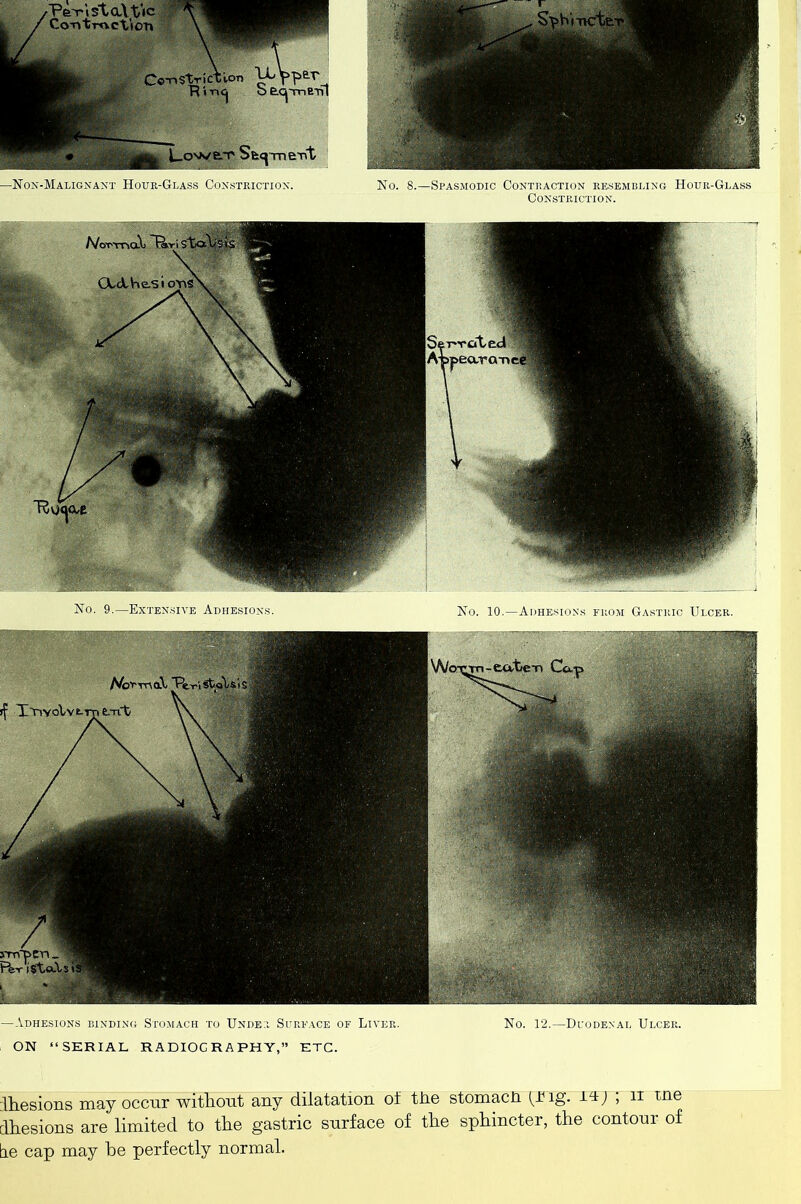 —Non-Malignant Hour-Glass Constriction. No. 8.—Spasmodic Contraction resembling Hour-Glass Constriction. —Adhesions binding Stomach to Under Surface of Liver. No. 12.—Duodenal Ulcer. ON “SERIAL RADIOGRAPHY,” ETC. ihesions may occur without any dilatation of the stomacn (Uig. ih; ; n me dhesions are limited to the gastric surface of the sphincter, the contour of tie cap may he perfectly normal.