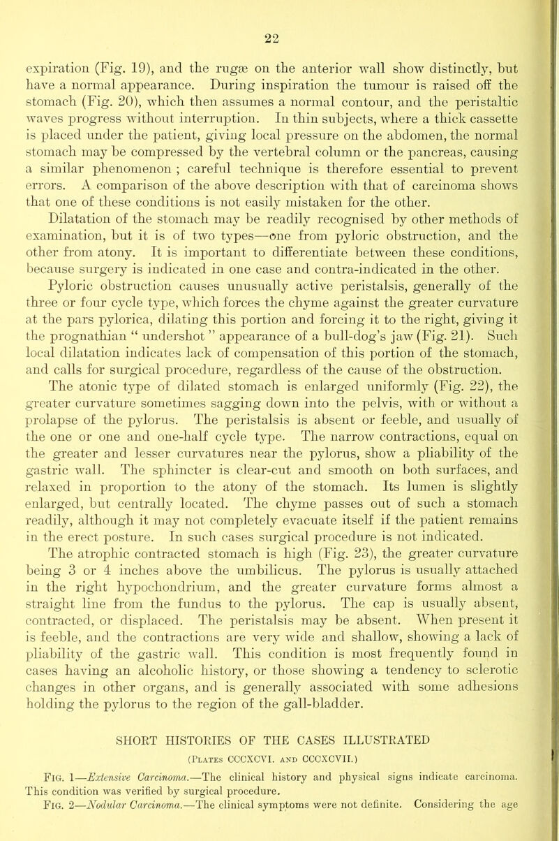 expiration (Fig. 19), and the rugae on the anterior wall show distinctly, bnt have a normal appearance. During inspiration the tumour is raised off the stomach (Fig. 20), which then assumes a normal contour, and the peristaltic waves progress without interruption. In thin subjects, where a thick cassette is placed under the patient, giving local pressure on the abdomen, the normal stomach may be compressed by the vertebral column or the pancreas, causing a similar phenomenon ; careful technique is therefore essential to prevent errors. A comparison of the above description with that of carcinoma shows that one of these conditions is not easily mistaken for the other. Dilatation of the stomach may be readily recognised by other methods of examination, but it is of two types—one from pyloric obstruction, and the other from atony. It is important to differentiate between these conditions, because surgery is indicated in one case and contra-indicated in the other. Pyloric obstruction causes unusually active peristalsis, generally of the three or four cycle type, which forces the chyme against the greater curvature at the pars p}dorica, dilating this portion and forcing it to the right, giving it the prognathian “ undershot ” appearance of a bull-dog’s jaw (Fig. 21). Such local dilatation indicates lack of compensation of this portion of the stomach, and calls for surgical procedure, regardless of the cause of the obstruction. The atonic type of difated stomach is enlarged uniformly (Fig. 22), the greater curvature sometimes sagging down into the pelvis, with or without a prolapse of the pylorus. The peristalsis is absent or feeble, and usually of the one or one and one-half cycle type. The narrow contractions, equal on the greater and lesser curvatures near the pylorus, show a pliability of the gastric wall. The sphincter is clear-cut and smooth on both surfaces, and relaxed in proportion to the atony of the stomach. Its lumen is slightly enlarged, but centrally located. The chyme passes out of such a stomach readily, although it may not completely evacuate itself if the patient remains in the erect posture. In such cases surgical procedure is not indicated. The atrophic contracted stomach is high (Fig. 23), the greater curvature being 3 or 4 inches above the umbilicus. The pylorus is usually attached in the right hypochondrium, and the greater curvature forms almost a straight line from the fundus to the pylorus. The cap is usually absent, contracted, or displaced. The peristalsis may be absent. When present it is feeble, and the contractions are very wide and shallow, showing a lack of pliability of the gastric wall. This condition is most frequently found in cases having an alcoholic history, or those showing a tendency to sclerotic changes in other organs, and is generally associated with some adhesions holding the pylorus to the region of the gall-bladder. SHORT HISTORIES OF THE CASES ILLUSTRATED (Plates CCCXCVI. and CCCXCVII.) Fig. 1—Extensive Carcinoma.—The clinical history and physical signs indicate carcinoma. This condition was verified by surgical procedure. Fig. 2—Nodular Carcinoma.—The clinical symptoms were not definite. Considering the age