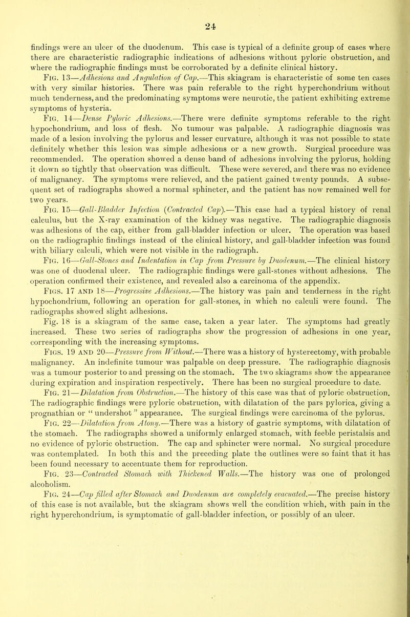 findings were an ulcer of the duodenum. This case is typical of a definite group of cases where there are characteristic radiographic indications of adhesions without pyloric obstruction, and where the radiographic findings must be corroborated by a definite clinical history. Fig. 13—Adhesions and Angulation of Cap.—This skiagram is characteristic of some ten cases with very similar histories. There was pain referable to the right hyperchondrium without much tenderness, and the predominating symptoms were neurotic, the patient exhibiting extreme symptoms of hysteria. Fig. 14—Dense Pyloric Adhesions.-—-There were definite symptoms referable to the right hypochondrium, and loss of flesh. No tumour was palpable. A radiographic diagnosis was made of a lesion involving the pylorus and lesser curvature, although it was not possible to state definitely whether this lesion was simple adhesions or a new growth. Surgical procedure was recommended. The operation showed a dense band of adhesions involving the pylorus, holding it down so tightly that observation was difficult. These were severed, and there was no evidence of malignancy. The symptoms were relieved, and the patient gained twenty pounds. A subse- quent set of radiographs showed a normal sphincter, and the patient has now remained well for two years. Fig. 15—Gall-Bladder Infection (Contracted Cap).—This case had a typical history of renal calculus, but the X-ray examination of the kidney was negative. The radiographic diagnosis was adhesions of the cap, either from gall-bladder infection or ulcer. The operation was based on the radiographic findings instead of the clinical history, and gall-bladder infection was found with biliary calculi, which were not visible in the radiograph. Fig. 16—Gall-Stones and Indentation in Cap from Pressure by Duodenum.—The clinical history was one of duodenal ulcer. The radiographic findings were gall-stones without adhesions. The operation confirmed their existence, and revealed also a carcinoma of the appendix. Figs. 17 and 18—Progressive Adhesions.—The history was pain and tenderness in the right hypochondrium, following an operation for gall-stones, in which no calculi were found. The radiographs showed slight adhesions. Fig. 18 is a skiagram of the same case, taken a year later. The symptoms had greatly increased. These two series of radiographs show the progression of adhesions in one year, corresponding with the increasing symptoms. Figs. 19 and 20—Pressure from Without.—There was a history of hysterectomy, with probable malignancy. An indefinite tumour was palpable on deep pressure. The radiographic diagnosis was a tumour posterior to and pressing on the stomach. The two skiagrams show the appearance during expiration and inspiration respectively. There has been no surgical procedure to date. Fig. 21—Dilatation from Obstruction.—The history of this case was that of pyloric obstruction. The radiographic findings were pyloric obstruction, with dilatation of the pars pylorica, giving a prognathian or “ undershot ” appearance. The surgical findings were carcinoma of the pylorus. Fig. 22—Dilatation from Atony.-—There was a history of gastric symptoms, with dilatation of the stomach. The radiographs showed a uniformly enlarged stomach, with feeble peristalsis and no evidence of pyloric obstruction. The cap and sphincter were normal. No surgical procedure was contemplated. In both this and the preceding plate the outlines were so faint that it has been found necessary to accentuate them for reproduction. Fig. 23—Contracted Stomach with Thickened Walls.—The history was one of prolonged alcoholism. Fig. 24—Cap filled after Stomach and Duodenum are completely evacuated.—The precise history of this case is not available, but the skiagram shows well the condition which, with pain in the right hyperchondrium, is symptomatic of gall-bladder infection, or possibly of an ulcer.