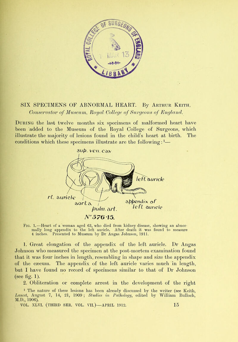 ■ SIX SPECIMENS OF ABNORMAL HEART. By Arthur Keith, Conservator of Musetim, Royal College of Surgeons of England. During the last twelve months six specimens of malfonned heart have been added to the Museum of the Royal College of Surgeons, which illustrate the majority of lesions found in the child’s heart at birth. The conditions which these specimens illustrate are the following: ^— 5u/j. ven. C2vv Fig. I.—Heart of a woman aged 63, who died from kidney disease, showing an abnor- mally long appendix to the left auricle. After death it was found to measure 4 inches. Presented to Museum by Dr Angas Johnson, 1911. 1. Great elongation of the appendix of the left auricle. Dr Angas Johnson who measured the specimen at the post-mortem examination found that it was four inches in length, resembling in shape and size the appendix of the csecum. The appendix of the left auricle varies much in length, but I have found no record of specimens similar to that of Dr Johnson (see fig. 1). 2. Obliteration or complete arrest in the development of the right 1 The nature of these lesions has been already discussed by the writer (see Keith, Lancet, August 7, 14, 21, 1909 ; Studies in Pathology, edited by William Bulloch, M.D., 1906). VOL. XLVI. (THIRD SEE. VOL. VII.)—APRIL 1912. 15