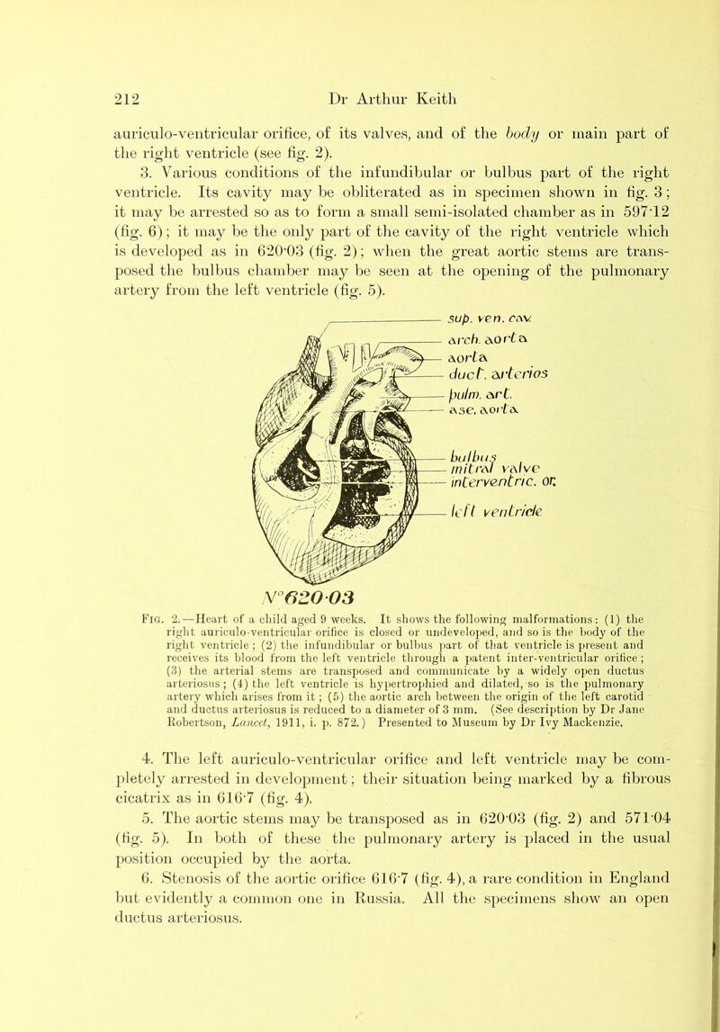 auriculo-ventricular orifice, of its valves, and of the hody or main part of the right ventricle (see fig. 2). 3. Various conditions of the infundibular or bulbus part of the right ventricle. Its cavity may be obliterated as in specimen shown in tig. 3; it may be arrested so as to form a small semi-isolated chamber as in 597'12 (hg. 6); it may be the only part of the cavity of the right ventricle which is developed as in 620'03 (fig. 2); when the great aortic stems are trans- posed the bulbus chamber may be seen at the opening of the pulmonary artery from the left ventricle (fig. 5). Fig. 2.—Heart of a cliild aged 9 weeks. It shows the following malformations: (1) the right auriculo-ventricular orifice is closed or undeveloped, and so is tlie liody of the right ventricle ; (2) the infundibular or bulbus jiart of that ventricle is present and receives its blood from the left ventricle througli a patent inter-ventricular orifice; (3) the arterial stems are transposed and communicate by a widely open ductus arteriosus ; (4) the left ventricle is hypertrophied and dilated, so is the pulmonary artery which arises from it; (5) the aortic arch between the origin of the left carotid and ductus arteriosus is reduced to a diameter of 3 mm. (See descriiition by Dr Jane Kohertson, Lancet, 1911, i. p. 872.) Presented to Museum by Dr Ivy Mackenzie. 4. The left auriculo-ventricular orifice and left ventricle may be com- pletely arrested in develojiment; their situation being marked by a fibrous cicatrix as in 616’7 (fig. 4). 5. The aortic stems may be transposed as in 620'03 (fig. 2) and 571’04 (fig. 5). In both of these the pulmonary artery is placed in the usual position occupied by the aorta. 6. Stenosis of the aortic orifice 616'7 (fig. 4), a rare condition in England but evidently a common one in Russia. All the specimens show an open ductus arteriosus. /■ sup. yen. cav Arch. AO rt A ft20 03